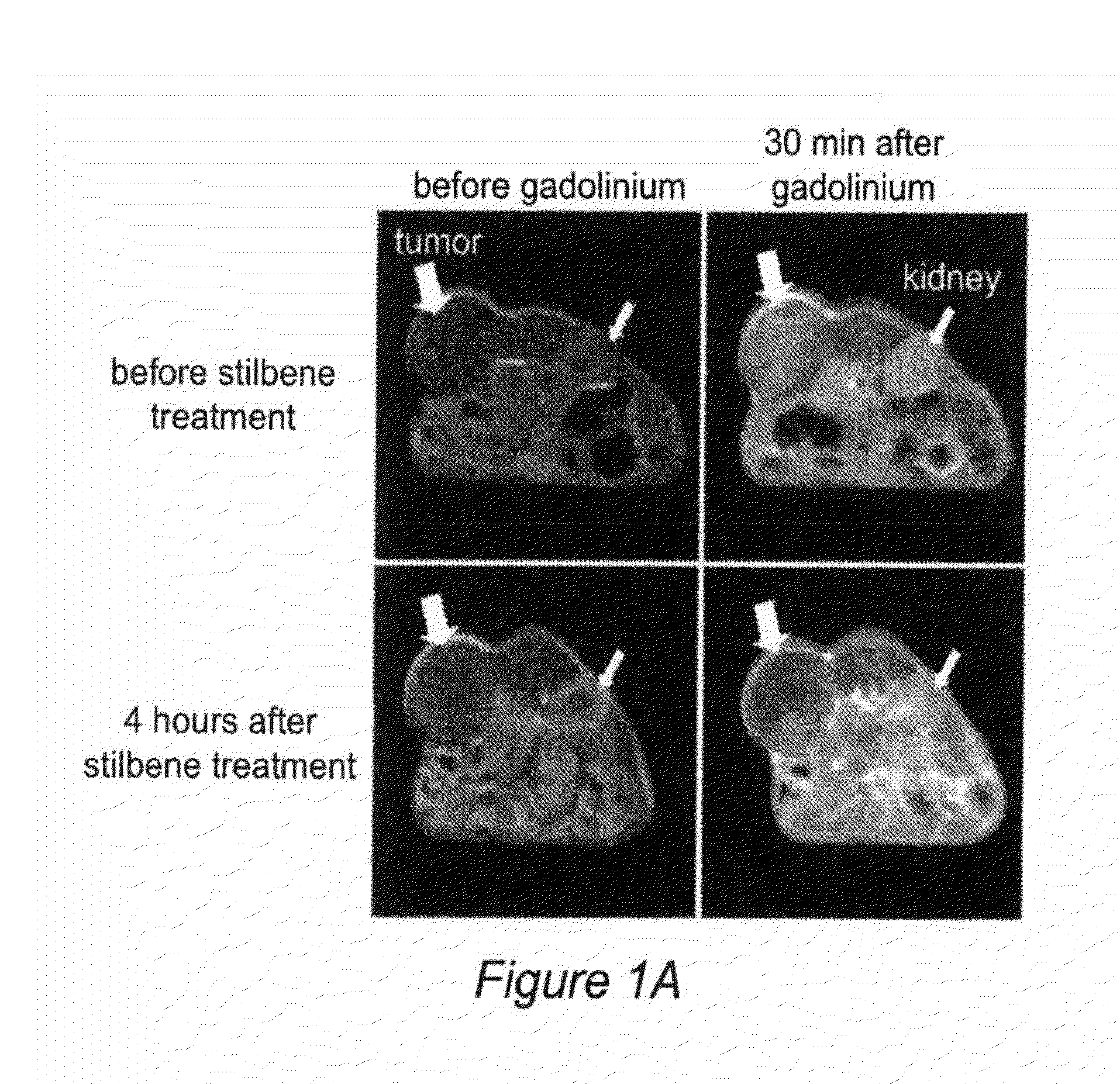 Induction of tumor hypoxia for cancer therapy