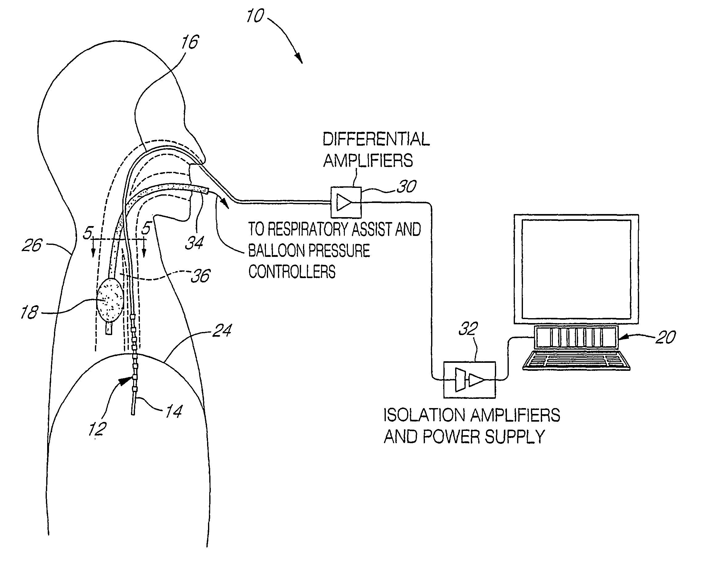 Myoelectrically activated respiratory leak sealing