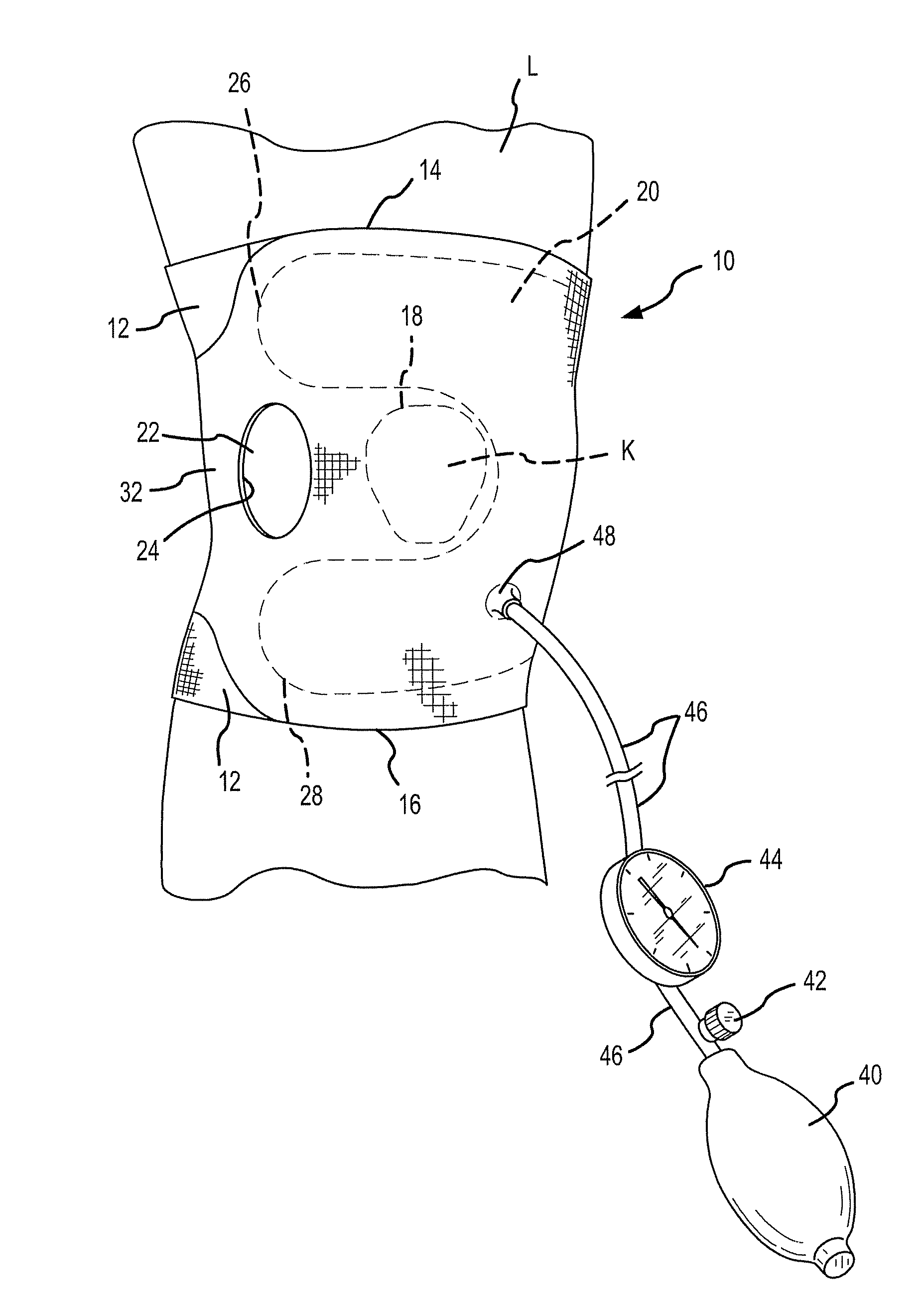 Joint Aspirate Facilitating Device