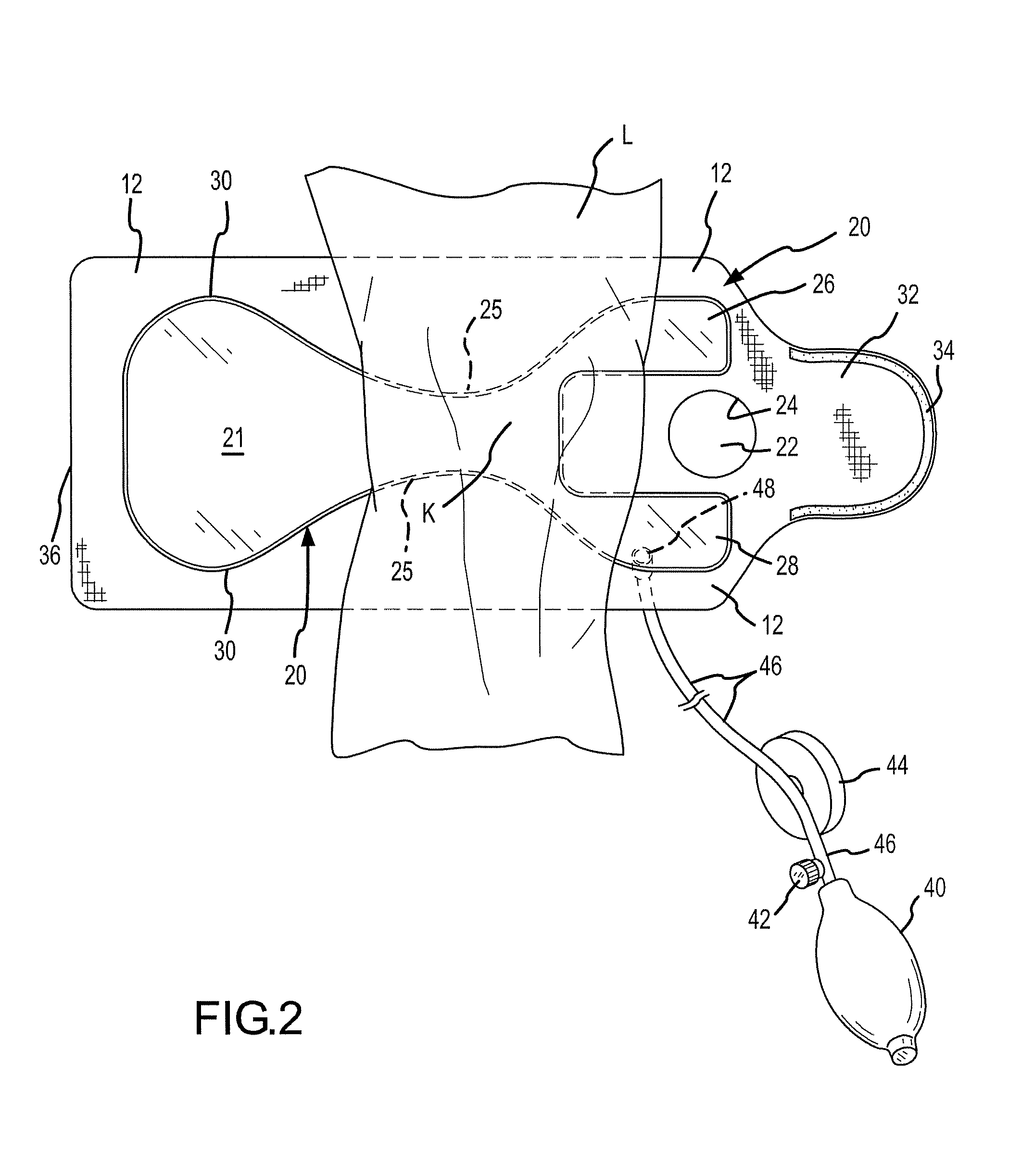 Joint Aspirate Facilitating Device