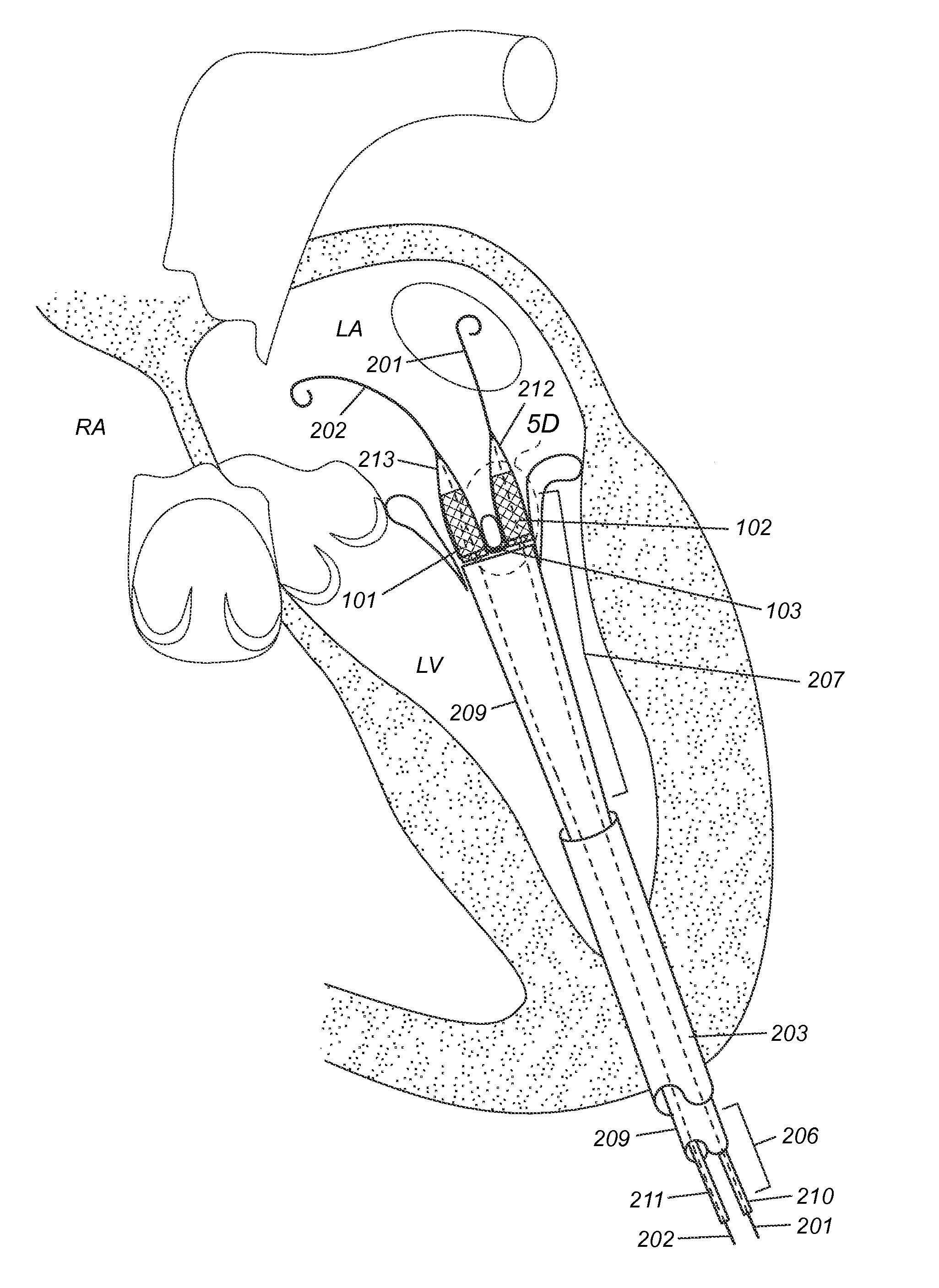 Methods, devices and systems for transcatheter mitral valve replacement in a double-orifice mitral valve