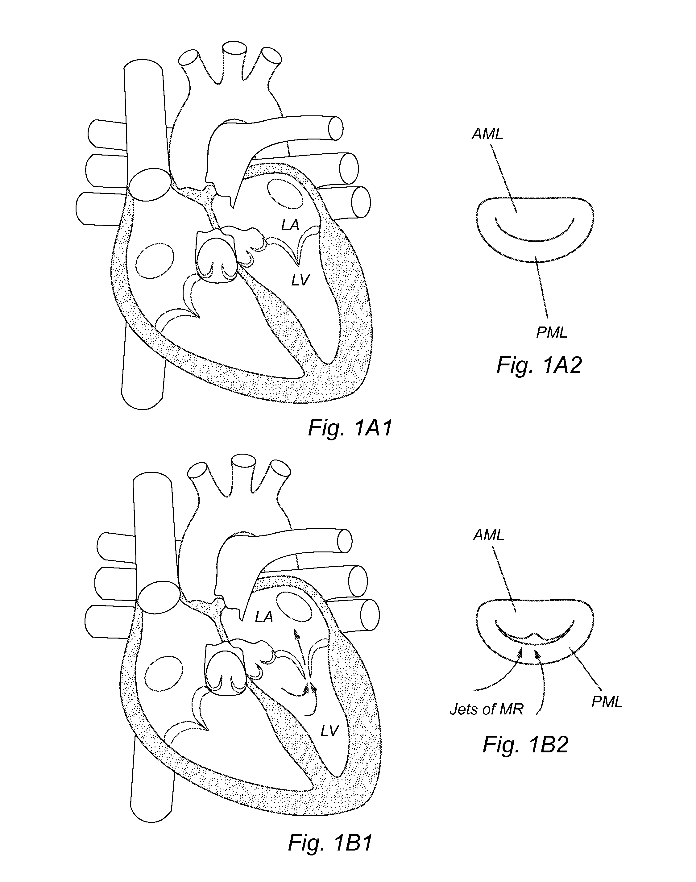 Methods, devices and systems for transcatheter mitral valve replacement in a double-orifice mitral valve