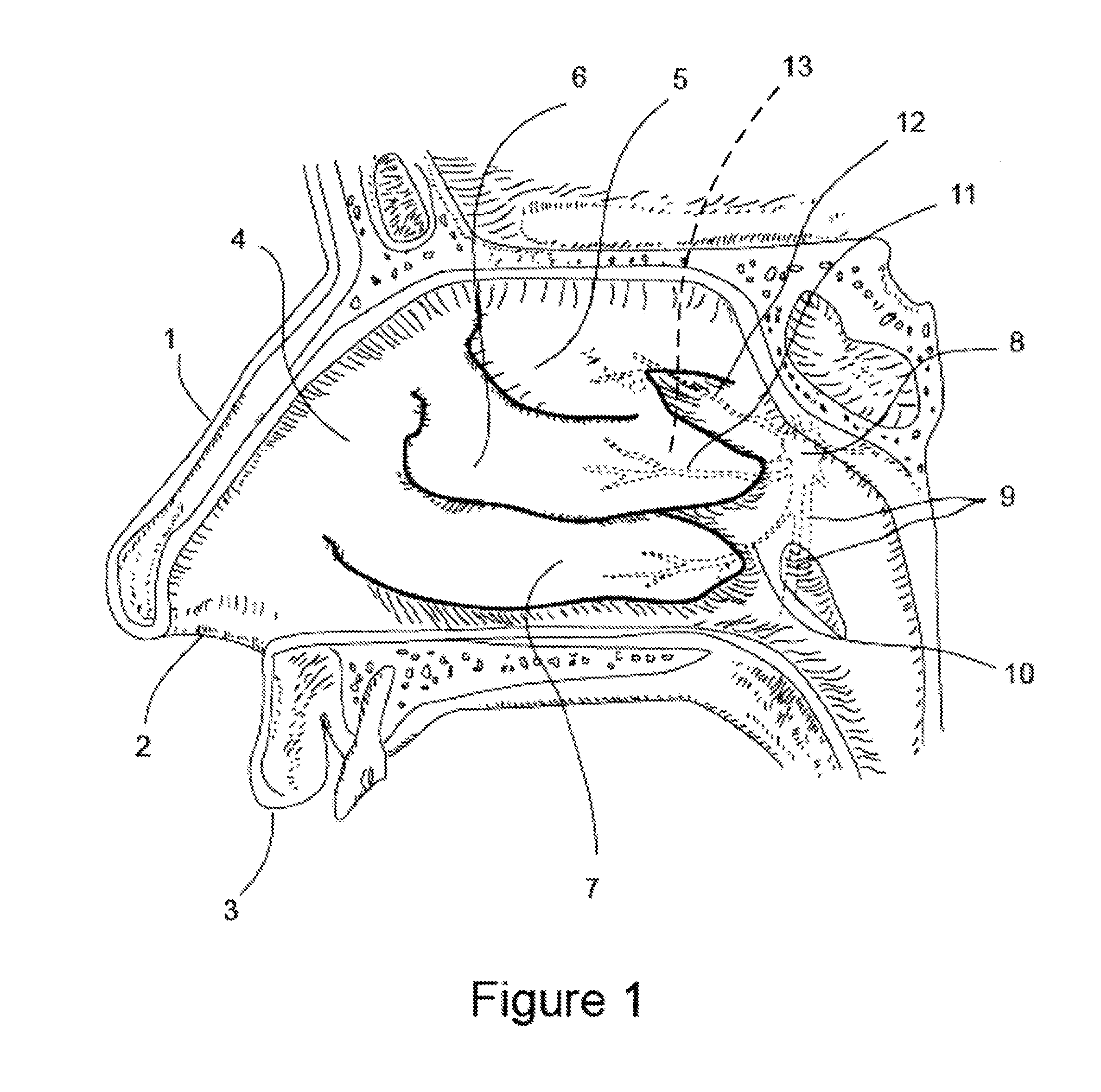 Apparatus and Methods for Treating Rhinitis