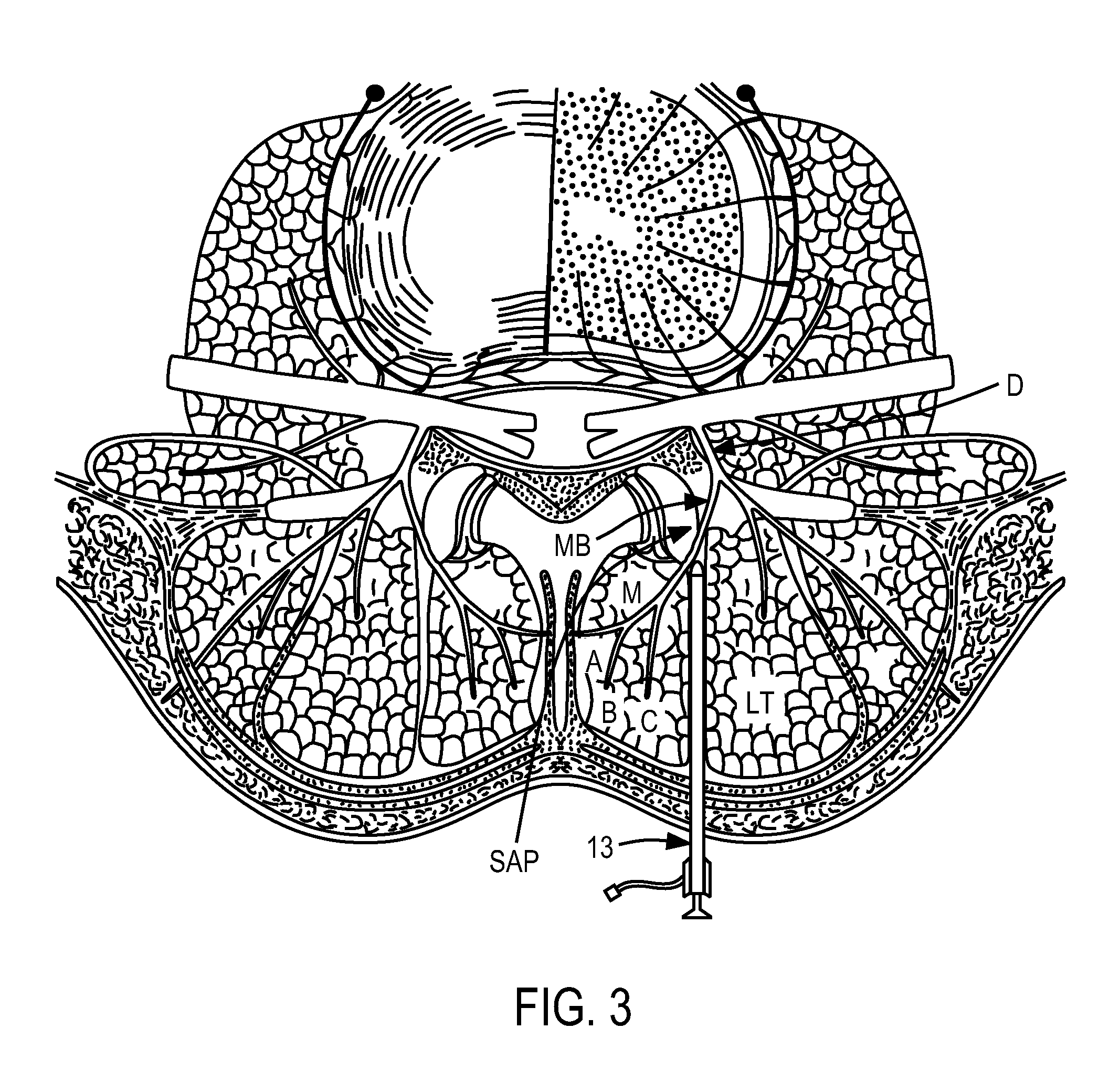 Methods of implanting electrode leads for use with implantable neuromuscular electrical stimulator