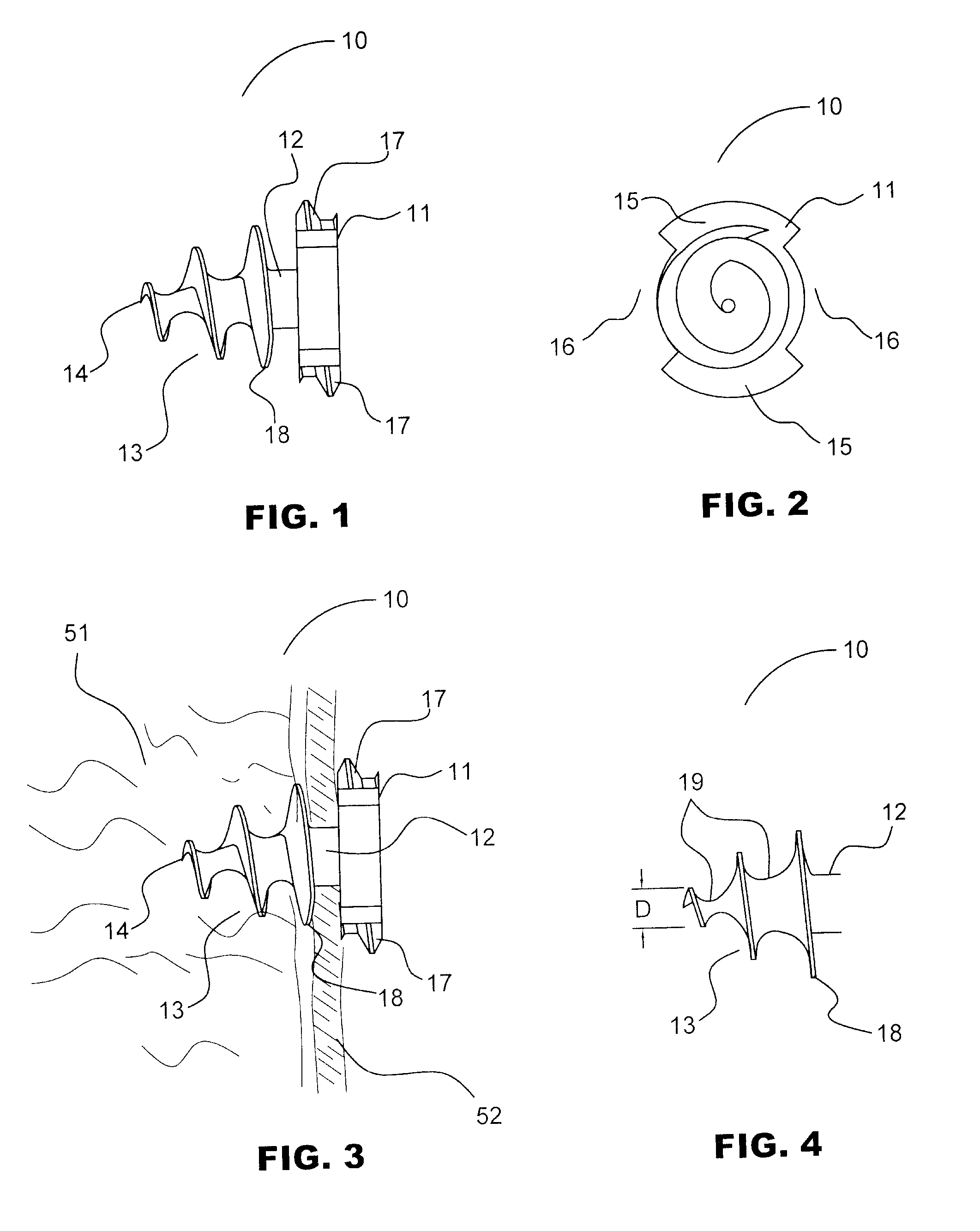 Absorbable Anchor for Hernia Mesh Fixation