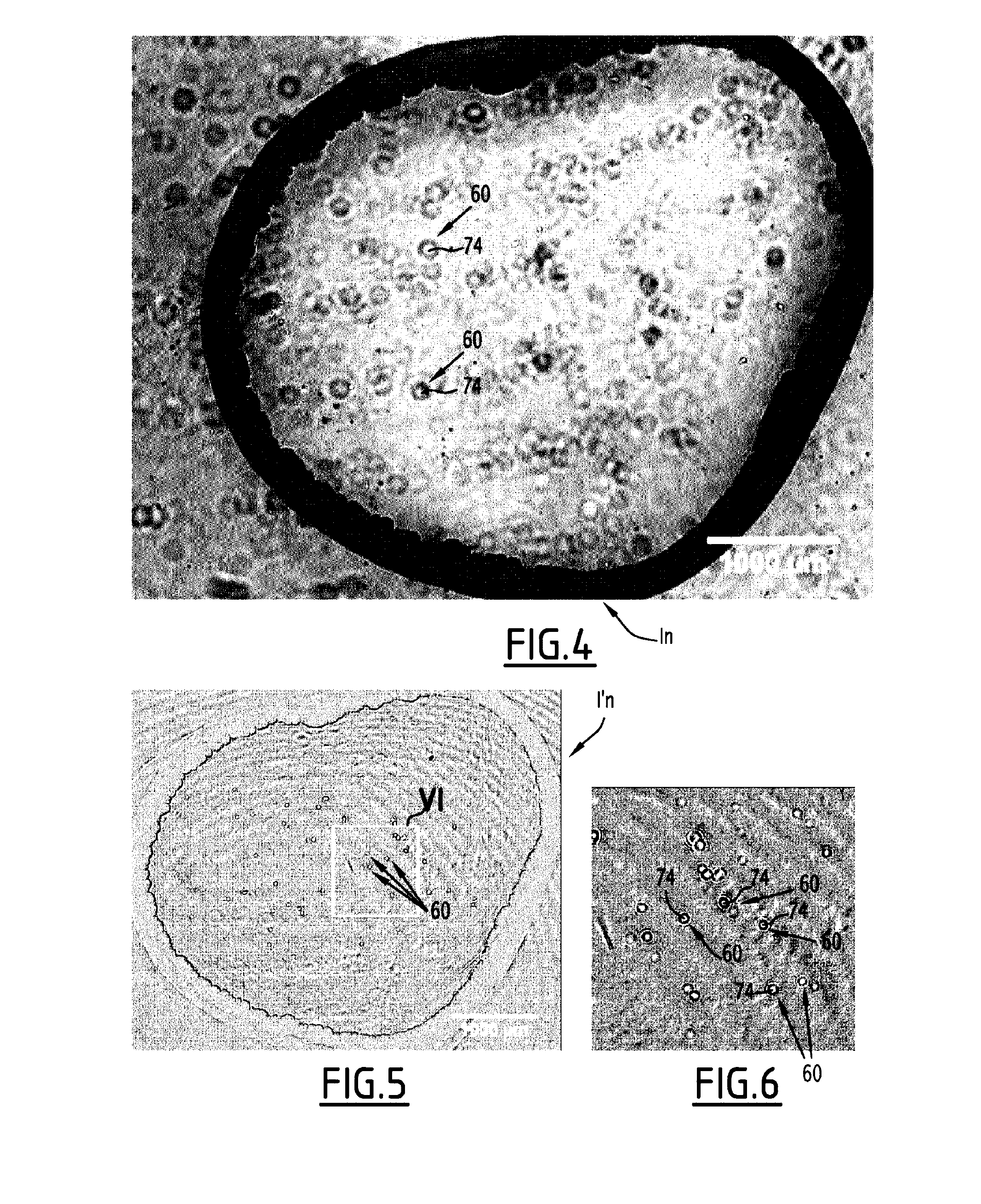 Method and system for detecting at least one particle in a bodily fluid, and associated method for diagnosing meningitis