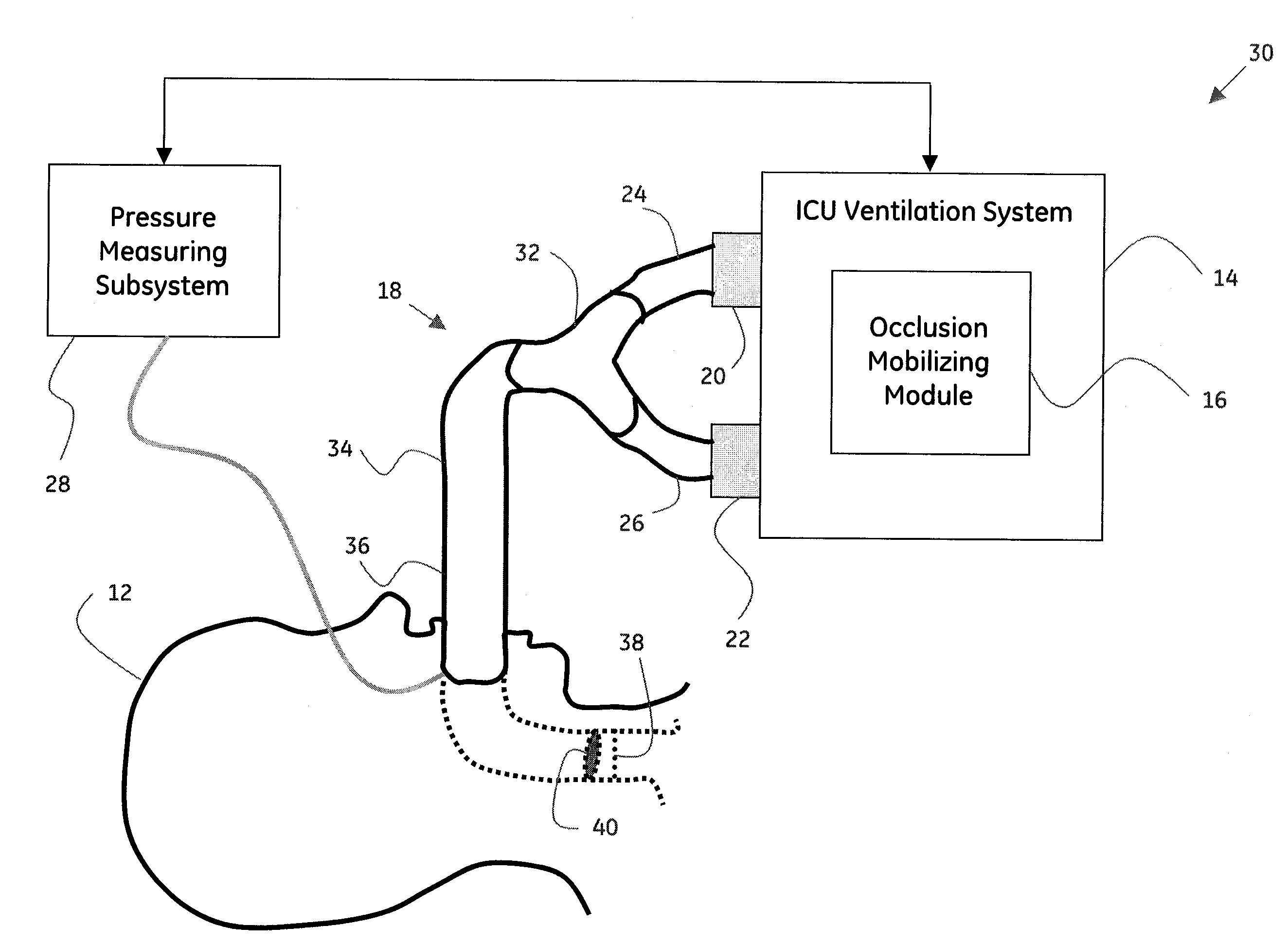 System and method for mobilizing occlusions from a breathing tube