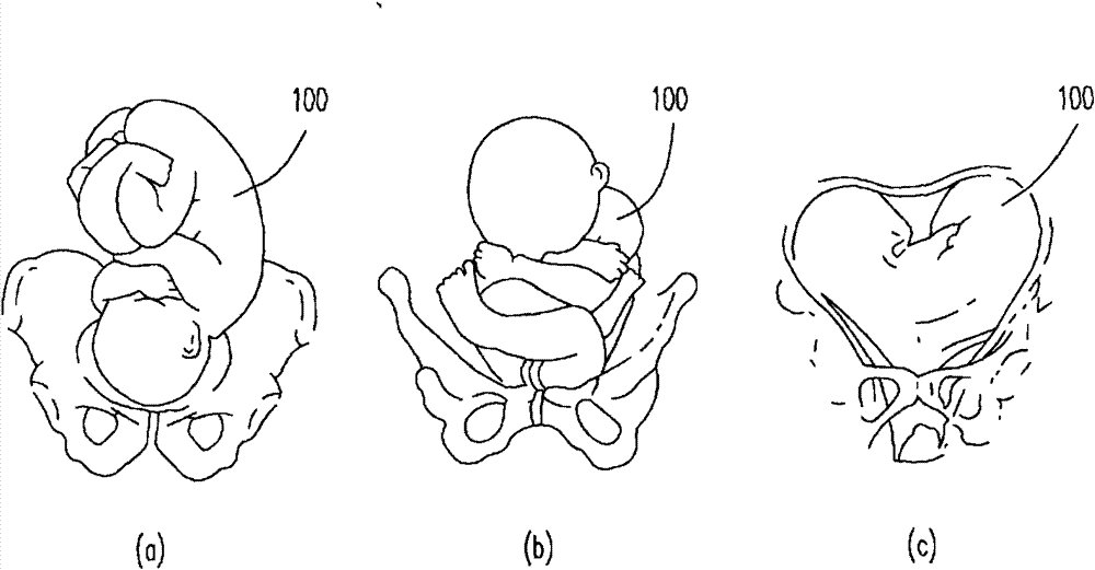 Maternal fetus monitoring device and method