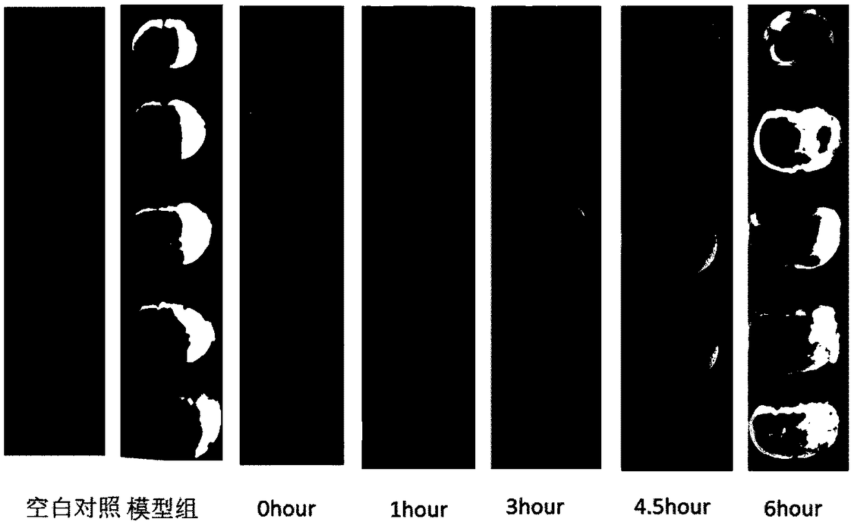 Application of artemisinin in prevention and treatment of cerebral apoplexy