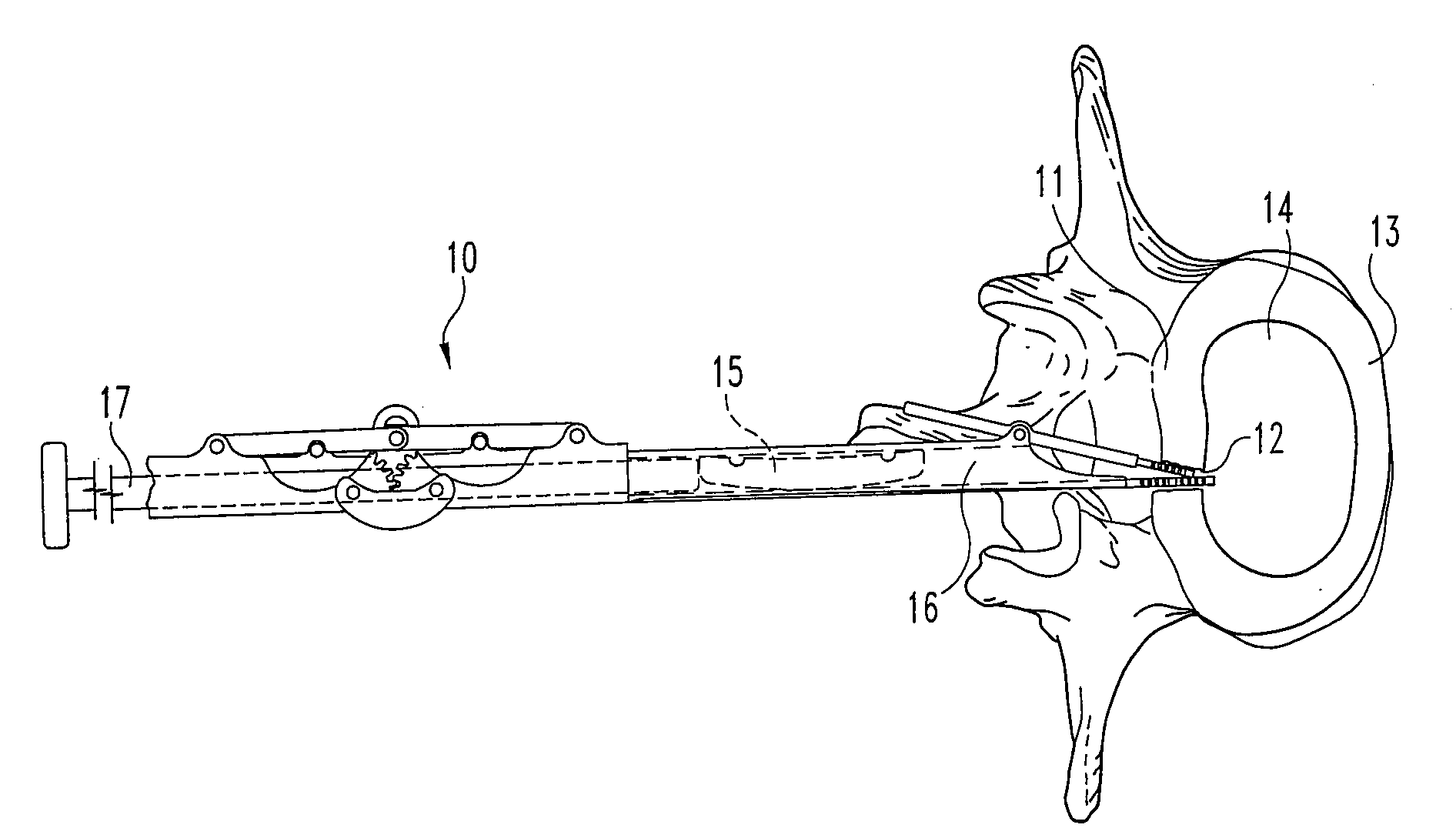 Method and apparatus for delivering an intervertebral disc implant