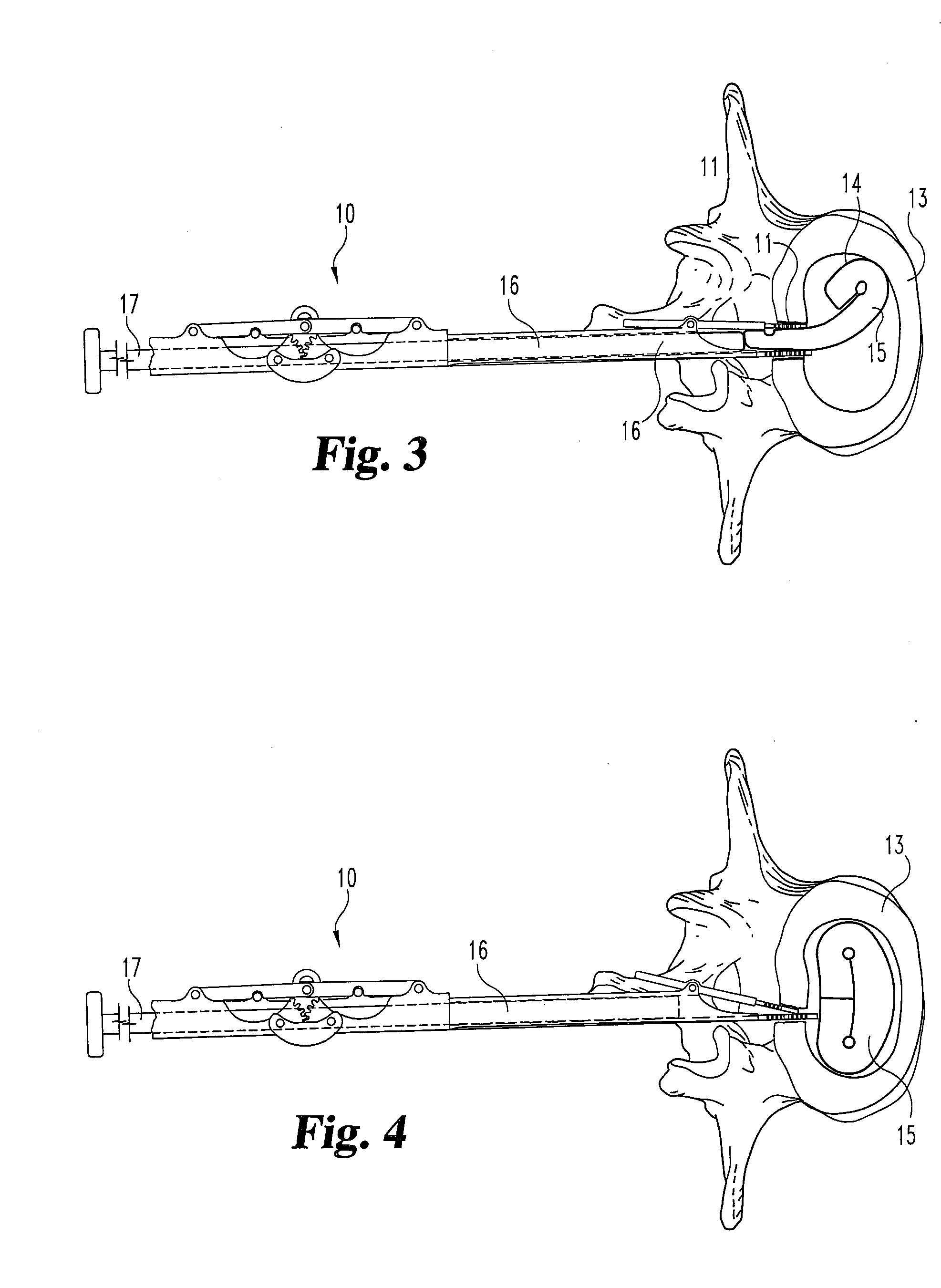 Method and apparatus for delivering an intervertebral disc implant