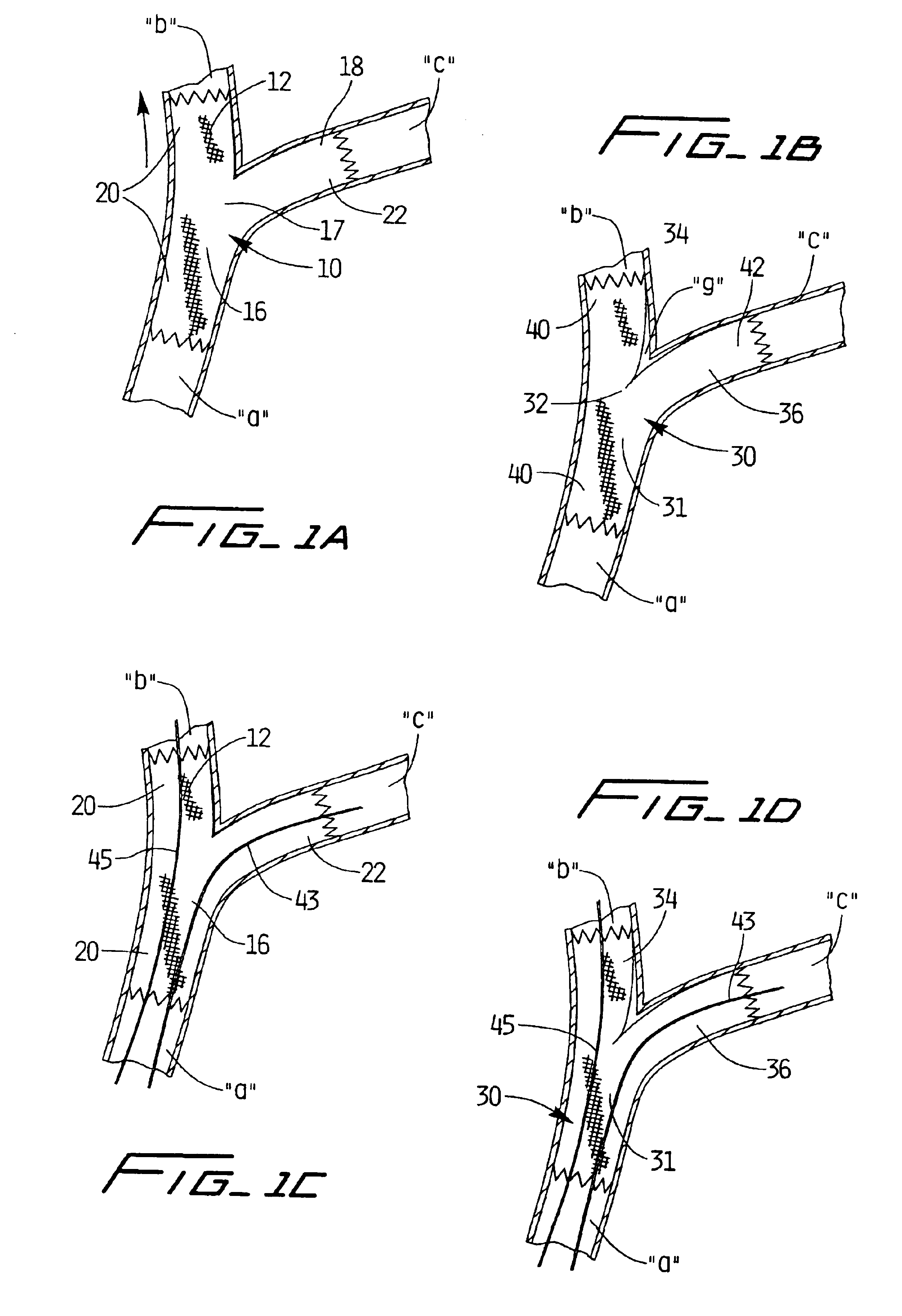 Covered stent with side branch