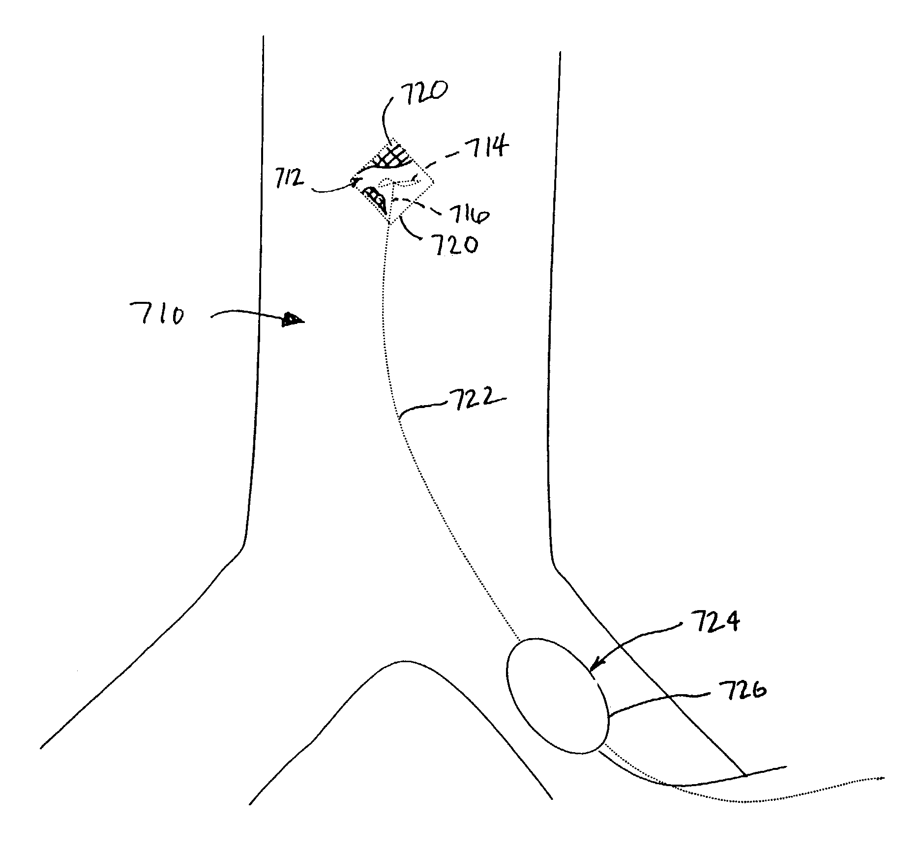 Implantable heart assist system and method of applying same