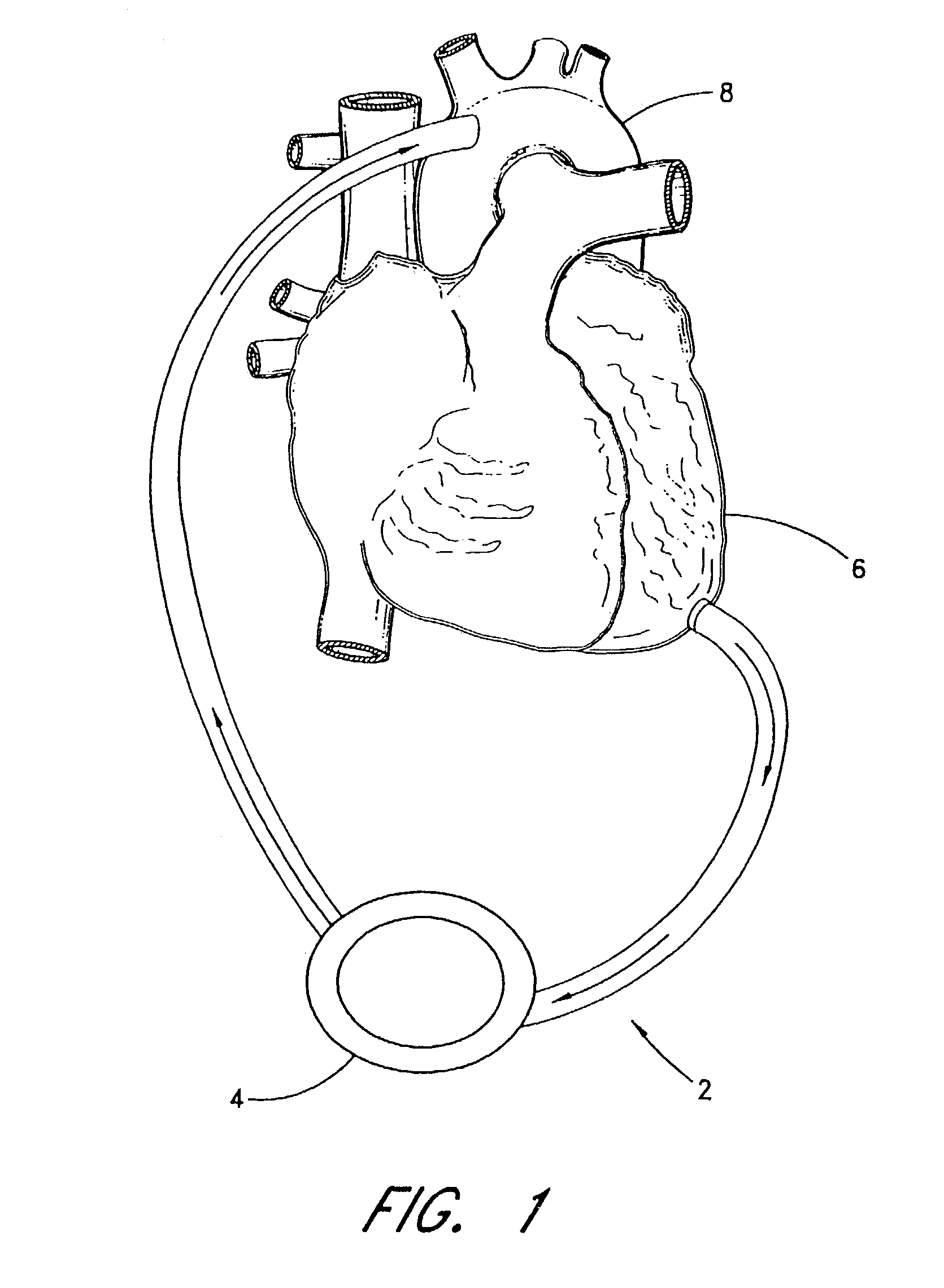 Implantable heart assist system and method of applying same