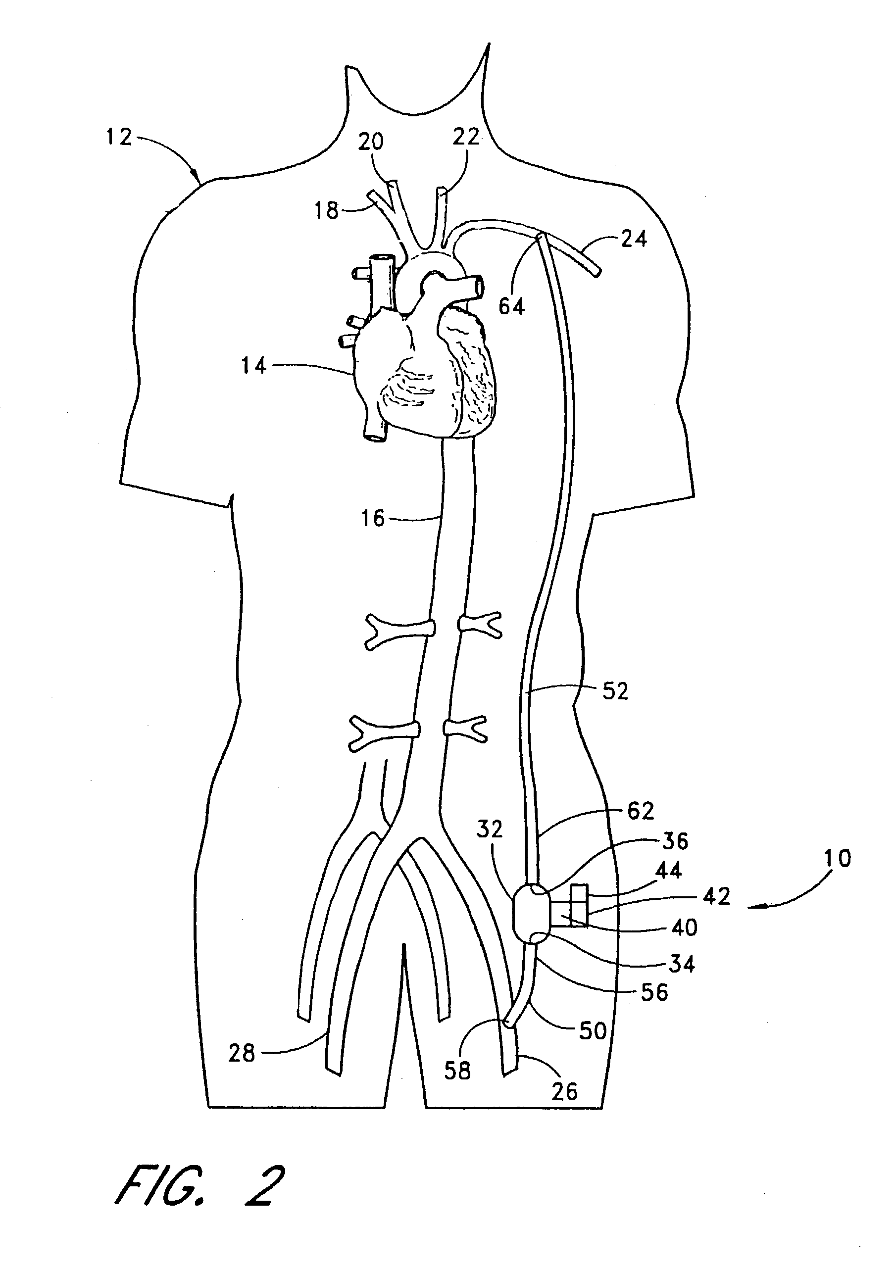 Implantable heart assist system and method of applying same