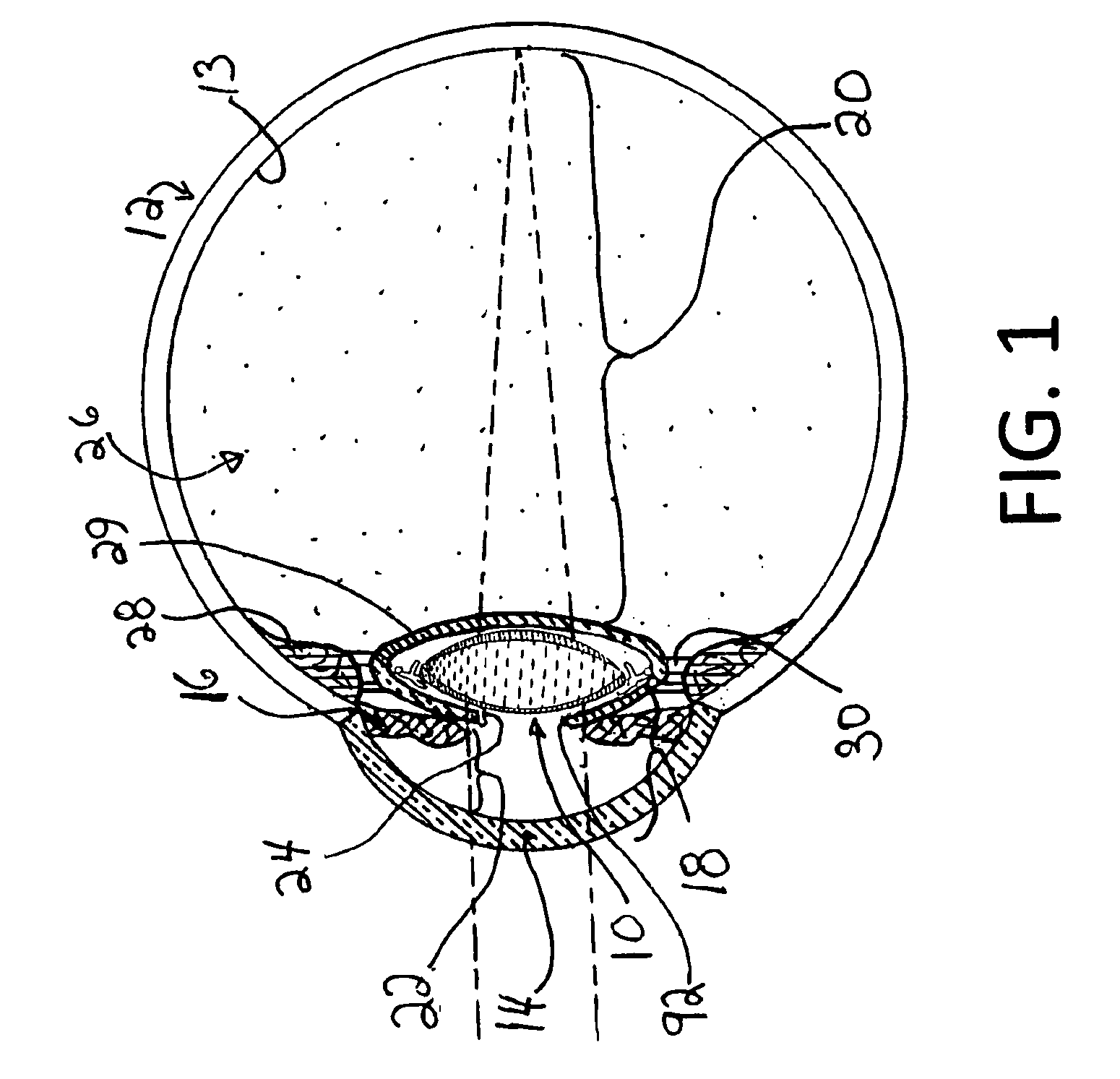 Accommodative intra-ocular lens