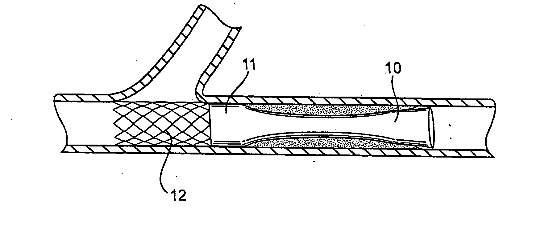 Methods and devices for protecting a passageway in a body when advancing devices through the passageway