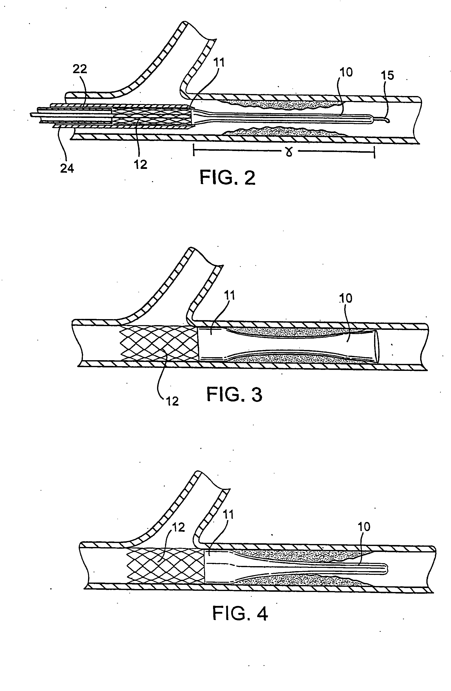 Methods and devices for protecting a passageway in a body when advancing devices through the passageway