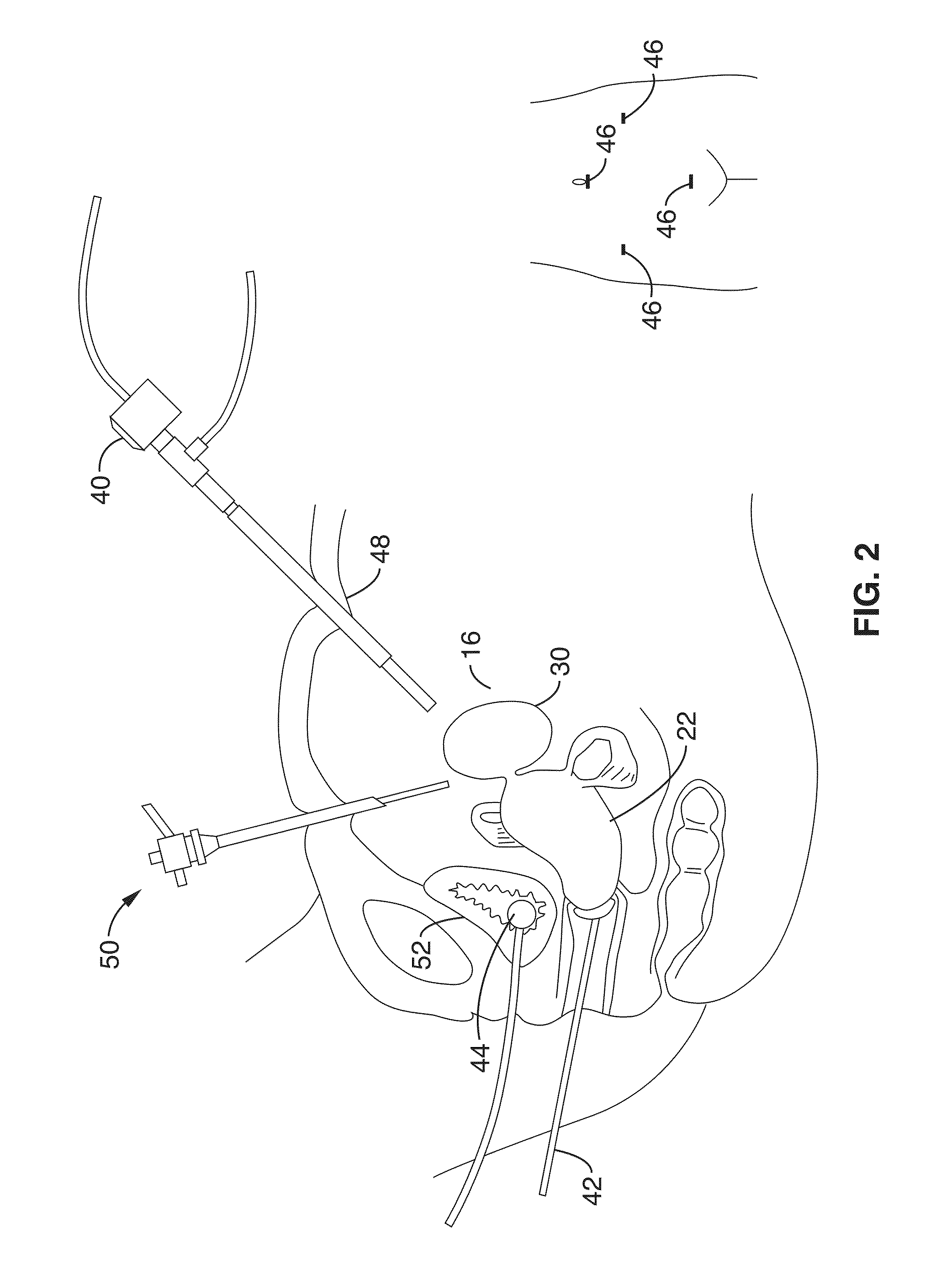 Method of thermal treatment for myolysis and destruction of benign uterine tumors