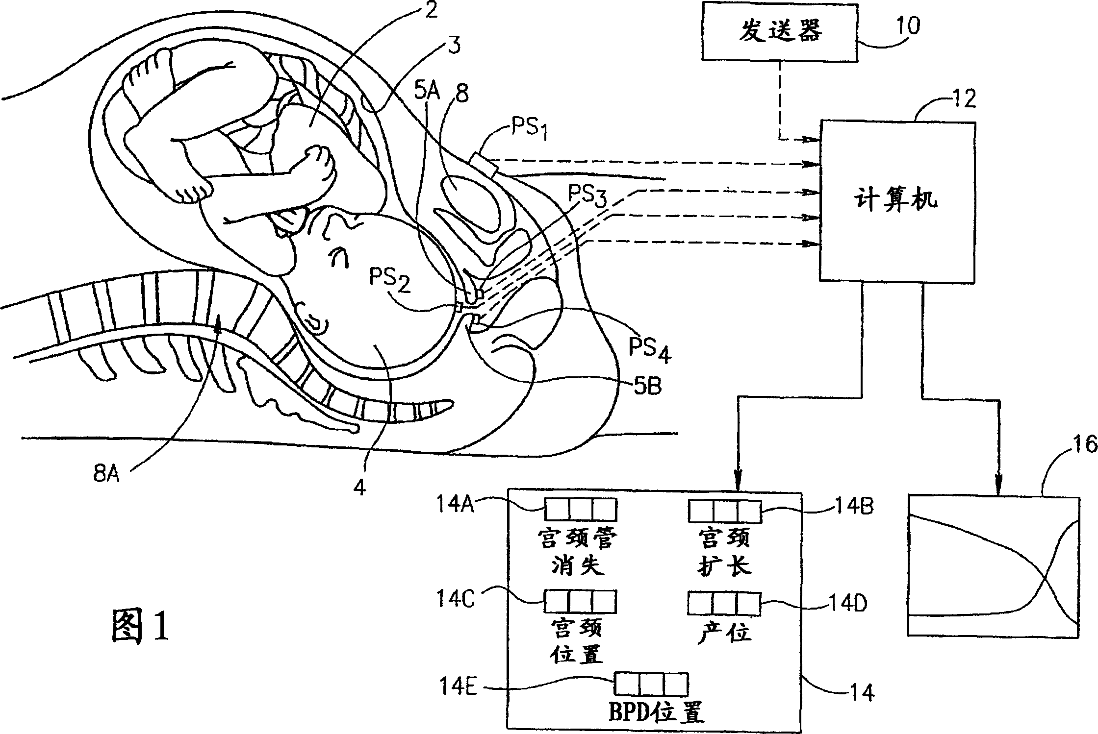 Method and apparatus for monitoring the progress of labor