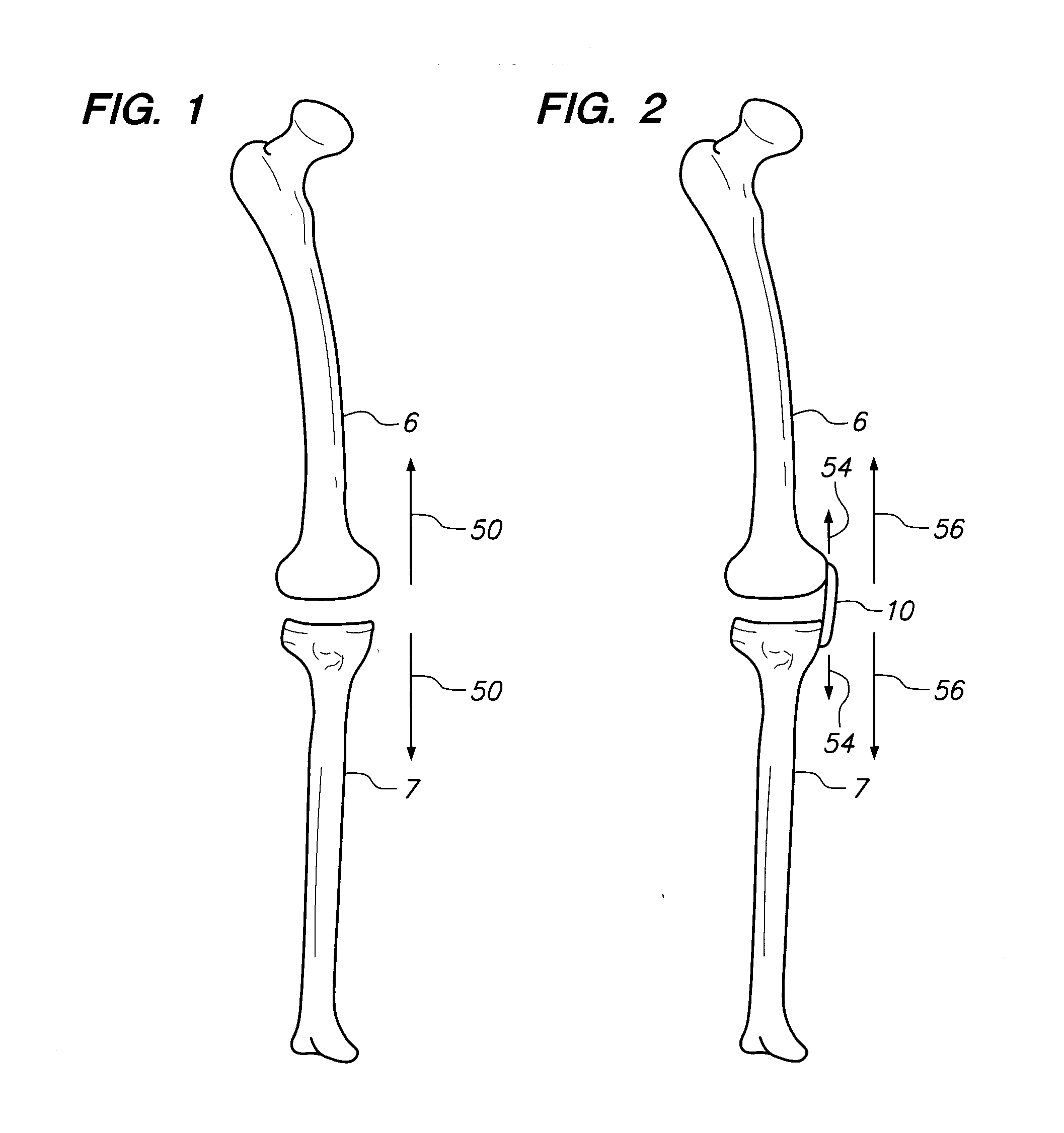 Extra-Articular Implantable Mechanical Energy Absorbing Assemblies and Methods