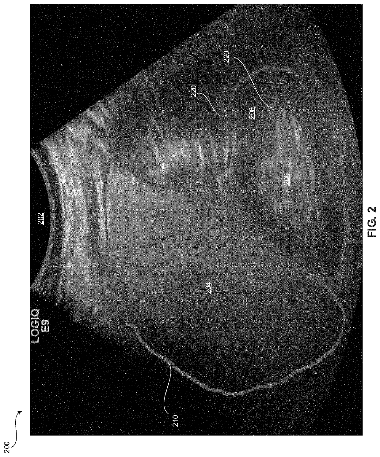 Method and system for automatically estimating a hepatorenal index from ultrasound images