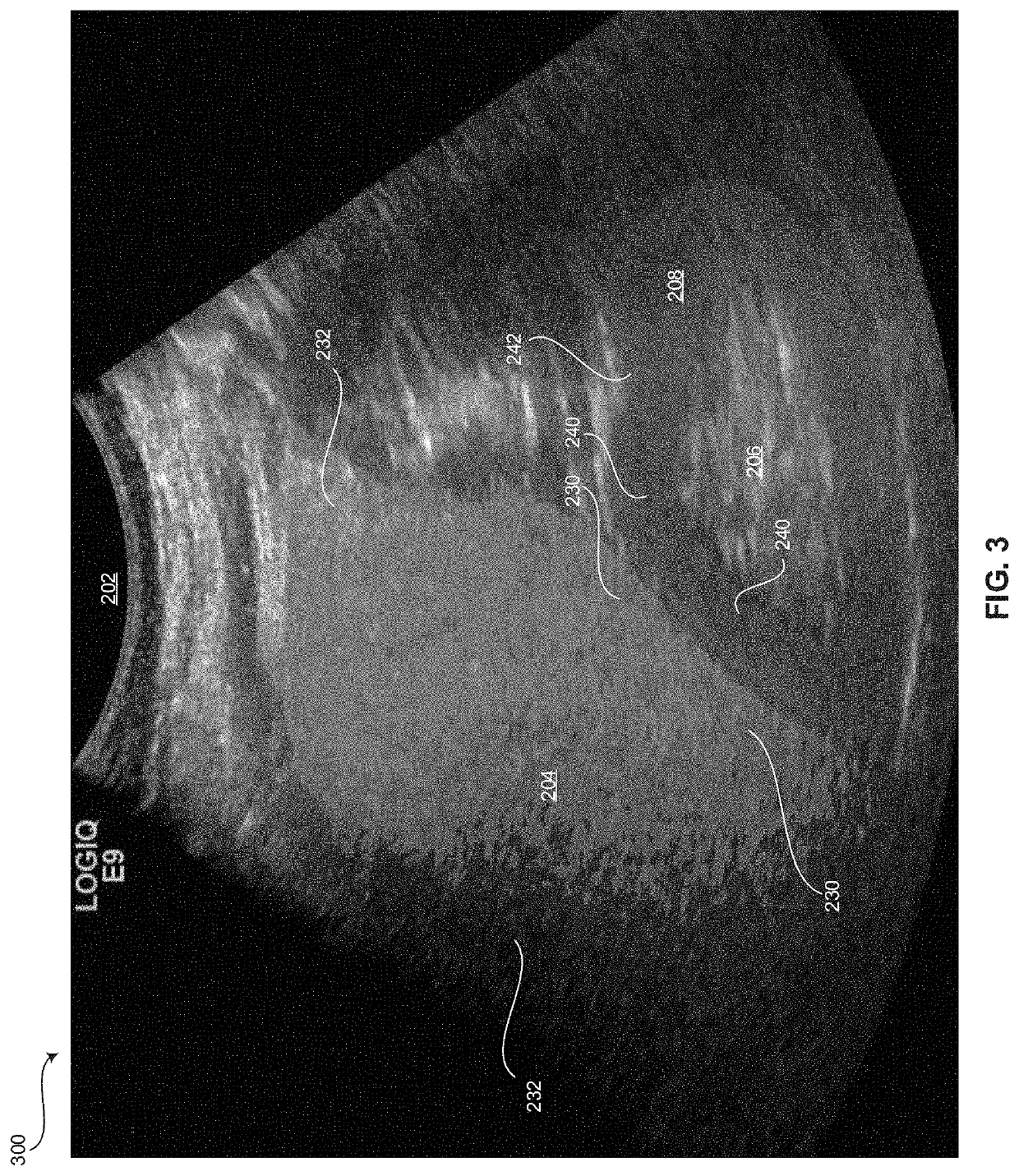 Method and system for automatically estimating a hepatorenal index from ultrasound images