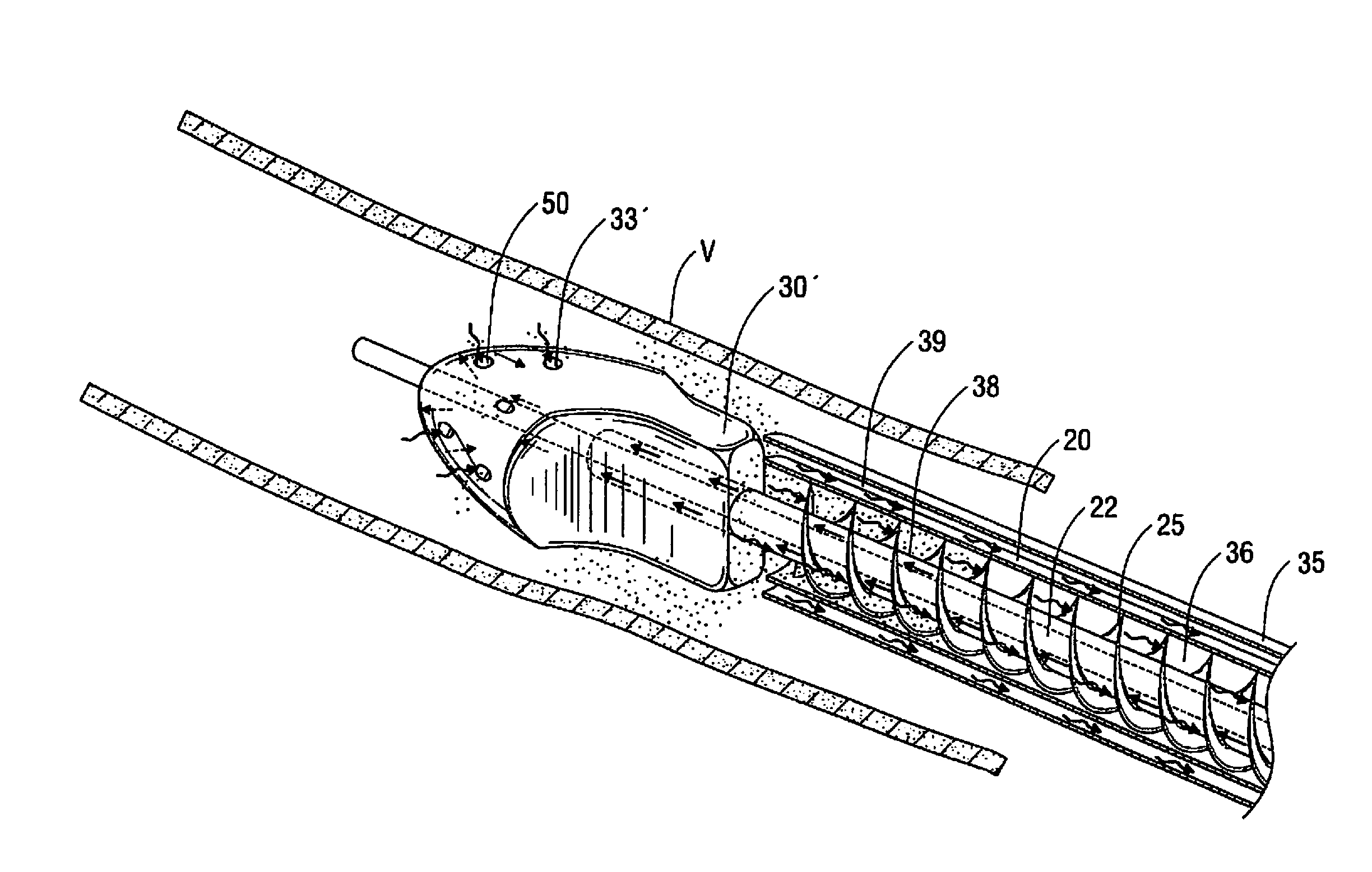 Atherectomy device