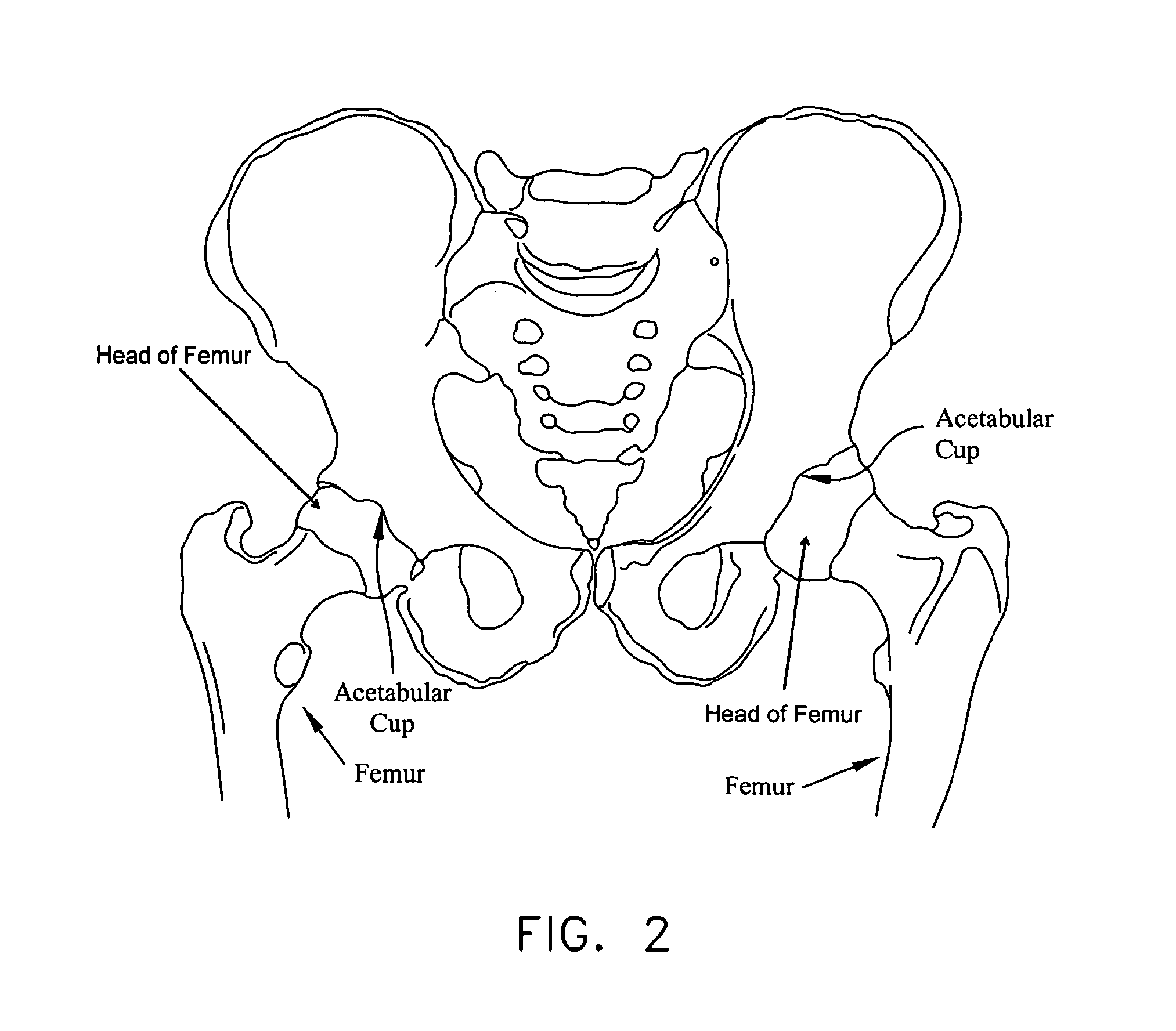 Method and apparatus for re-attaching the labrum to the acetabulum, including the provision and use of a novel suture anchor system