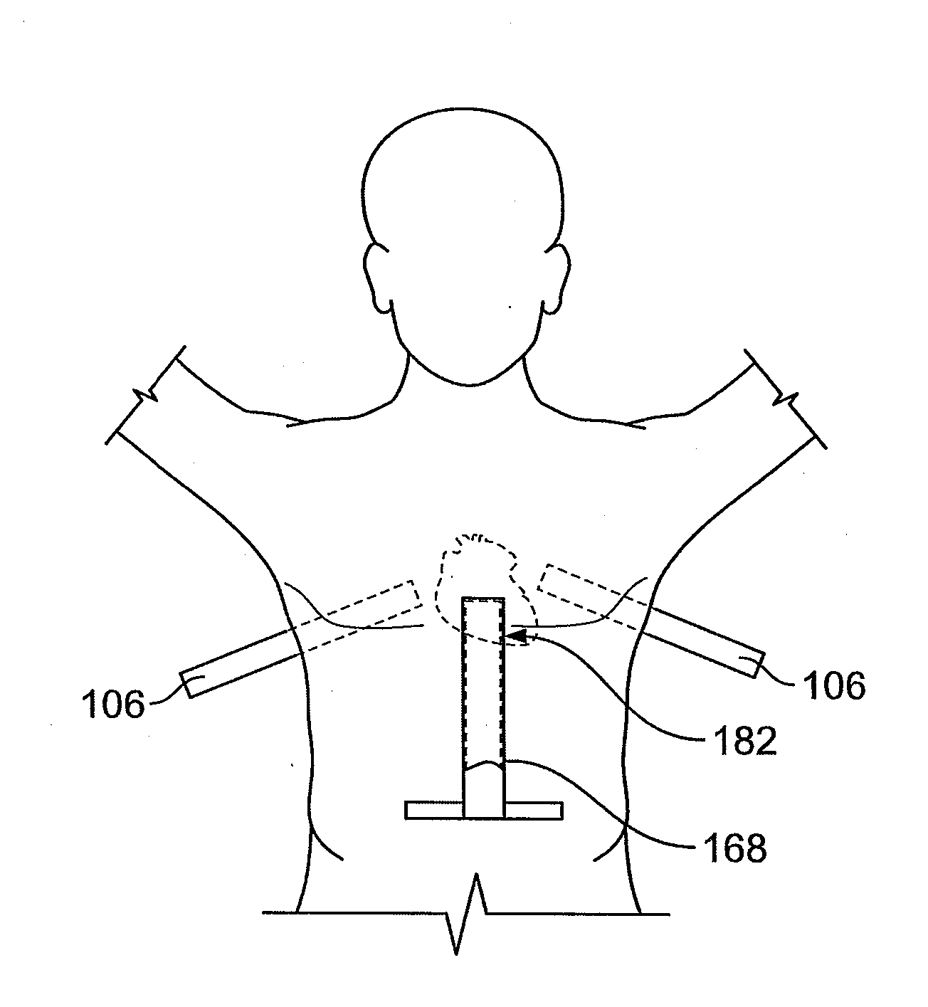 Diaphragm entry for posterior surgical access