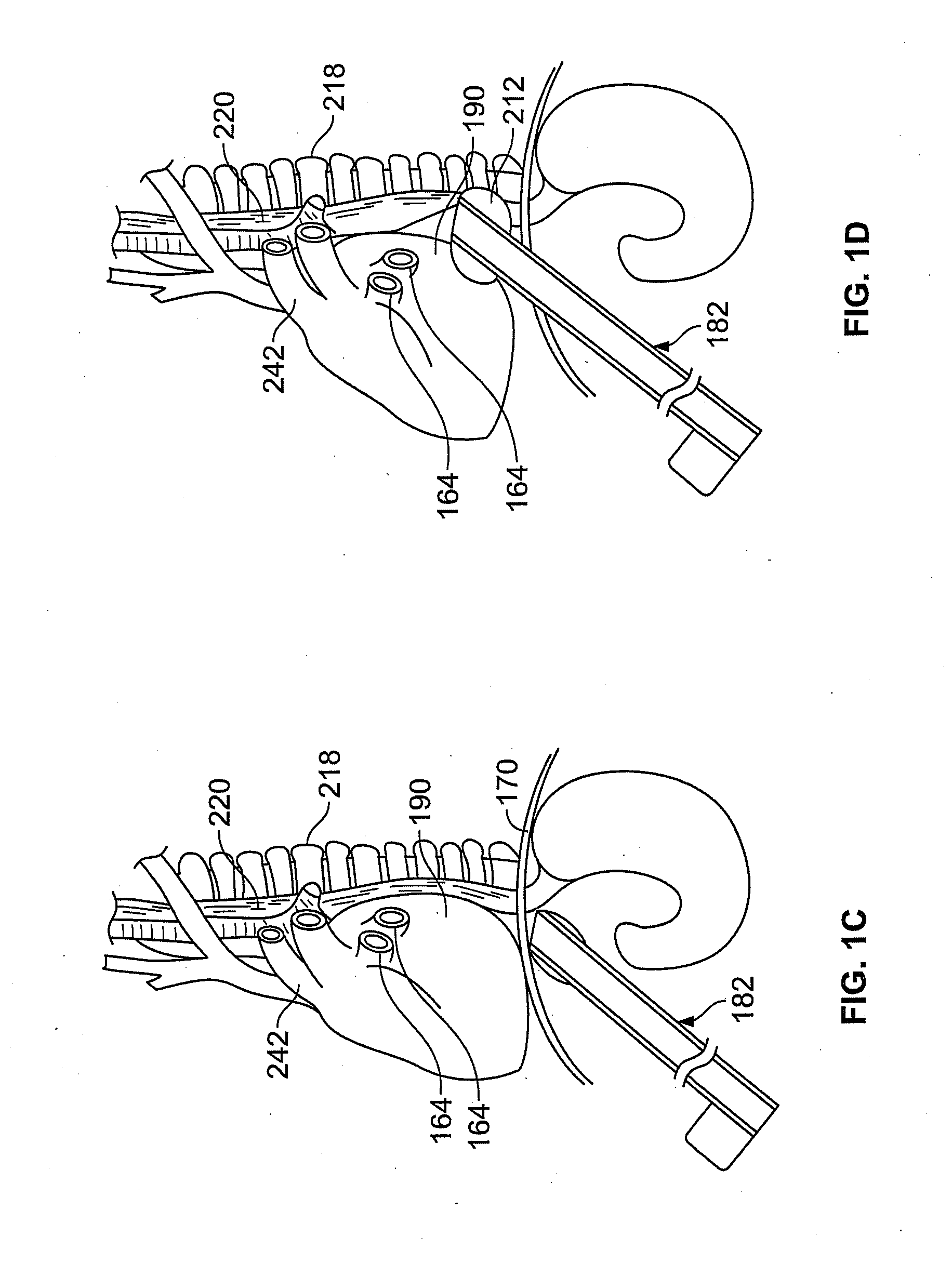 Diaphragm entry for posterior surgical access