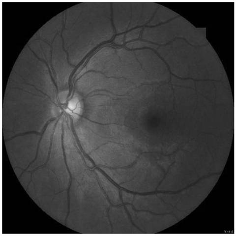 High-precision fundus blood vessel extraction method, device, medium, equipment and system