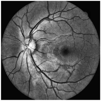 High-precision fundus blood vessel extraction method, device, medium, equipment and system