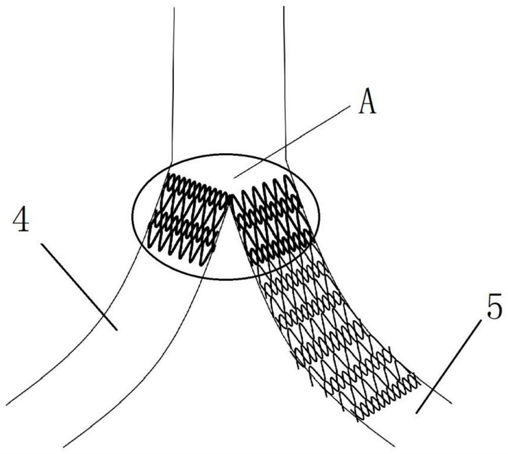 Split iliac vein stent and placement method thereof