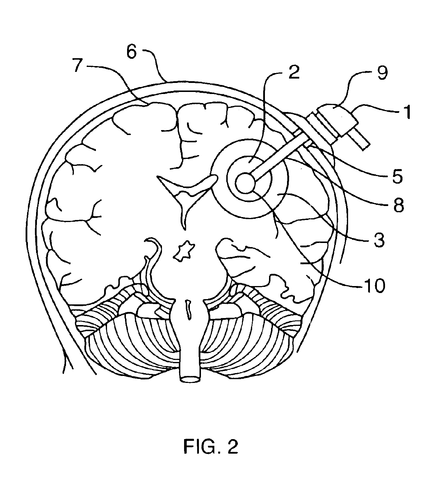 Method and device for reducing death and morbidity from stroke