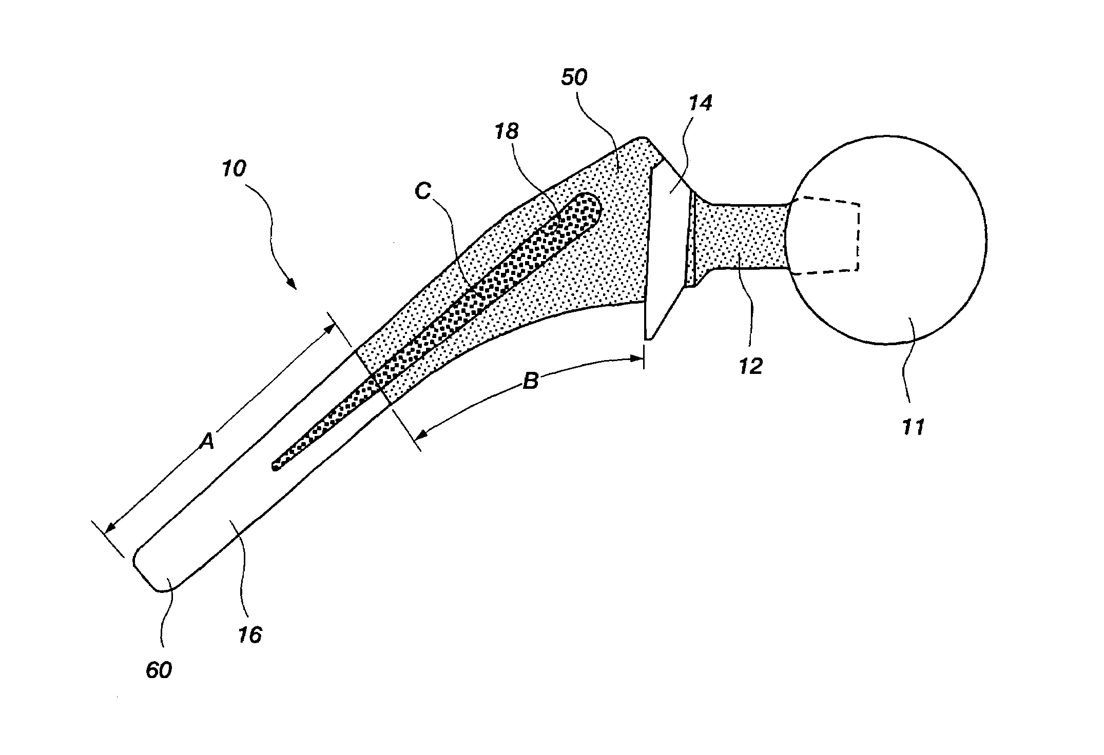 Differential porosity prosthetic hip system