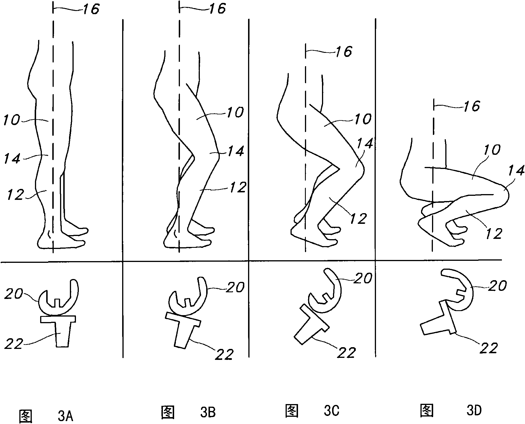 Anterior stabilized knee implant