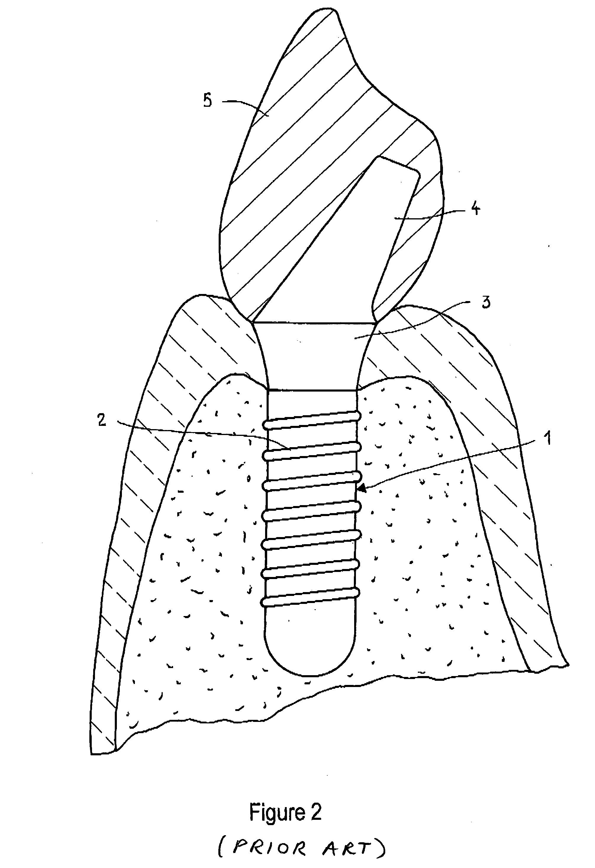 Try-in implant with angulated attachment portion