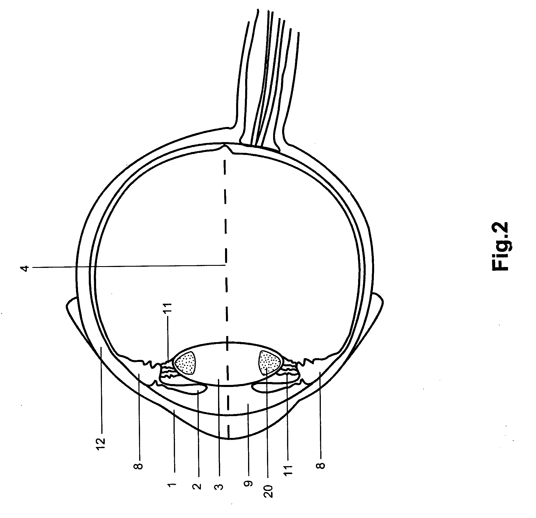 A method and a system for laser photoablation within a lens