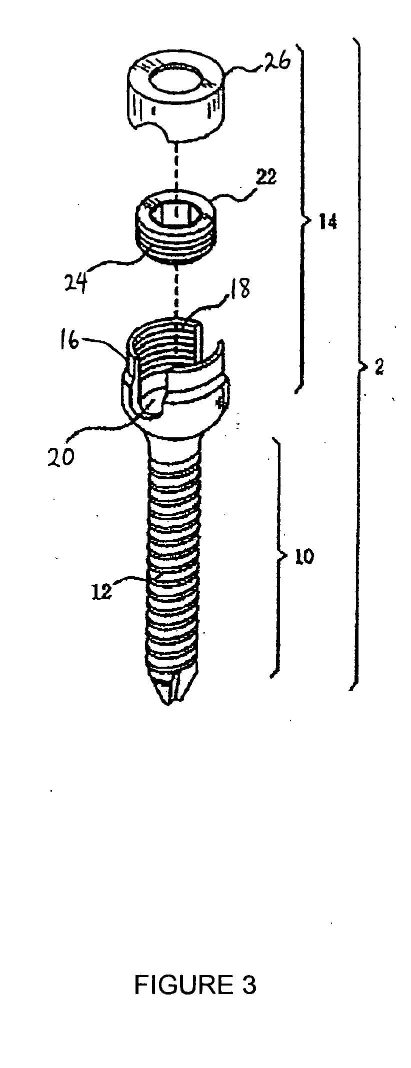 Method and apparatus for flexible fixation of a spine