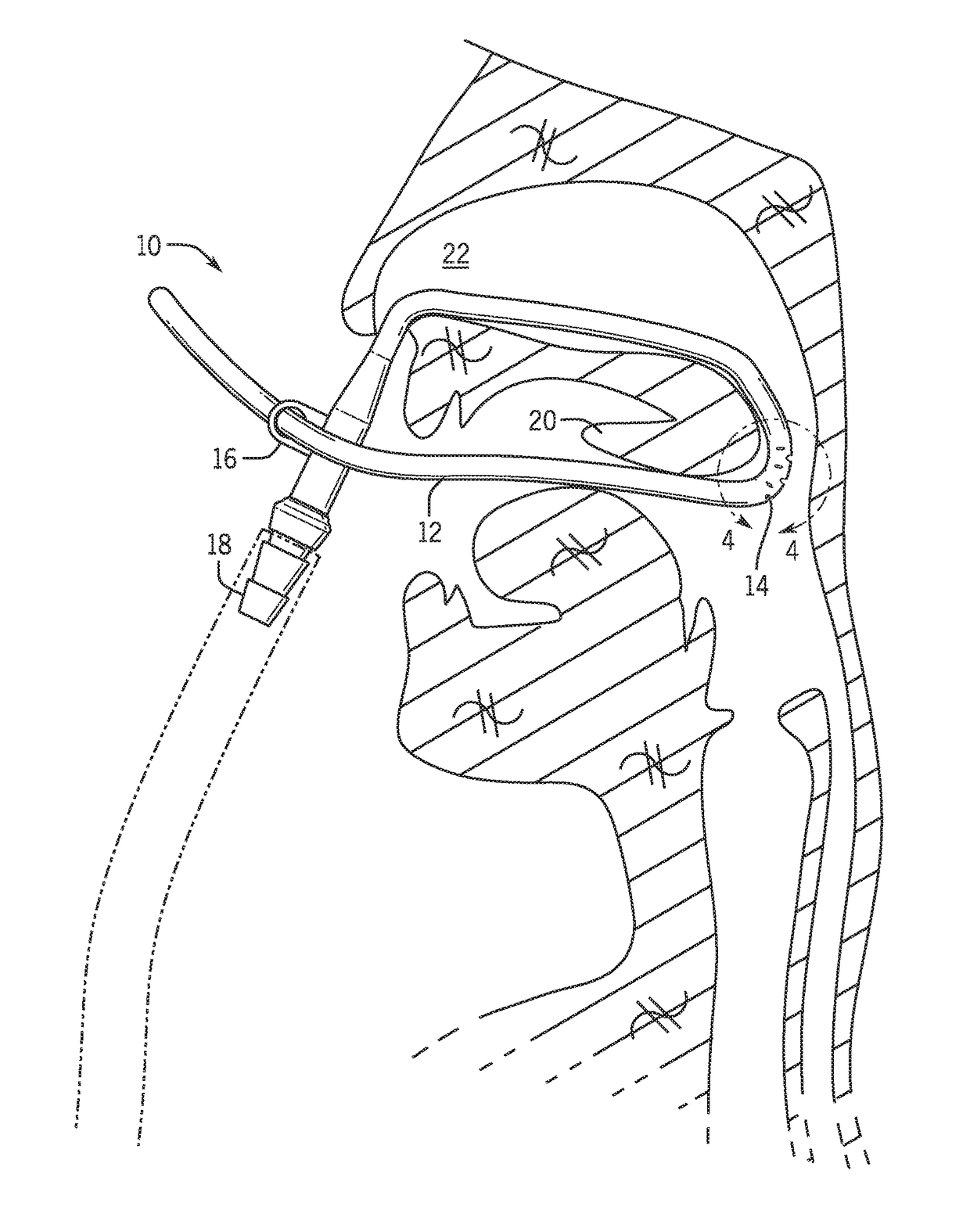 Retractor suction catheter