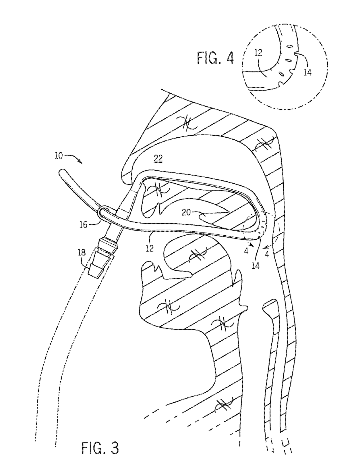 Retractor suction catheter