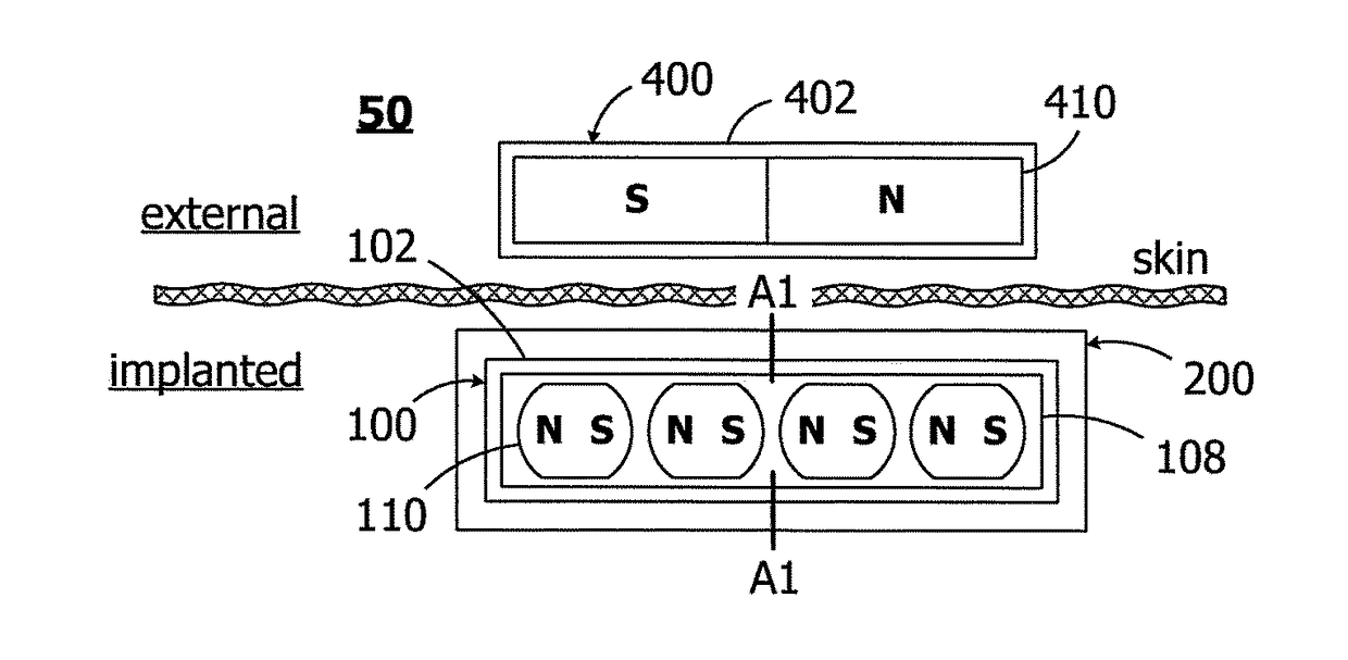 Cochlear implants having mri-compatible magnet apparatus and associated methods