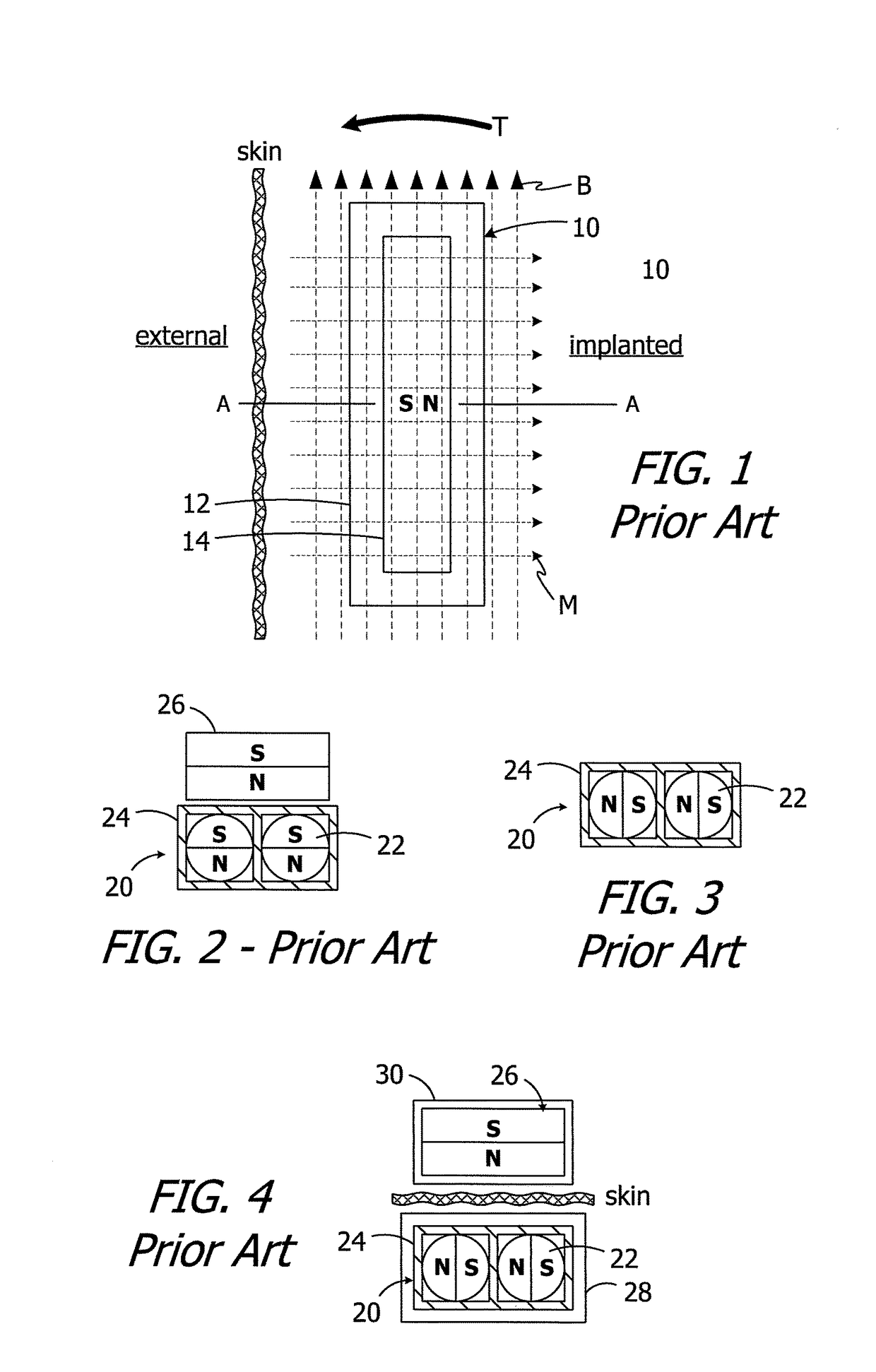 Cochlear implants having mri-compatible magnet apparatus and associated methods