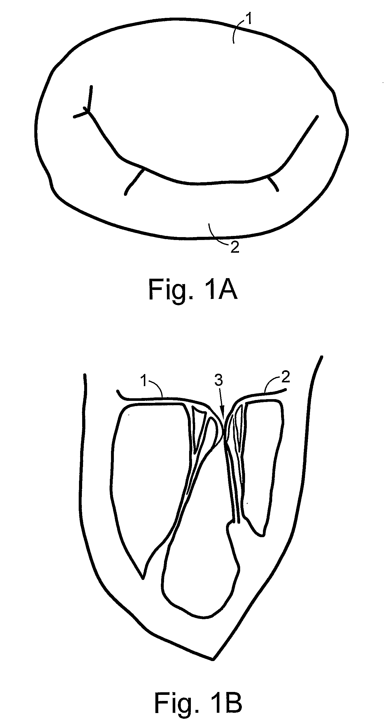 Heart valve repair