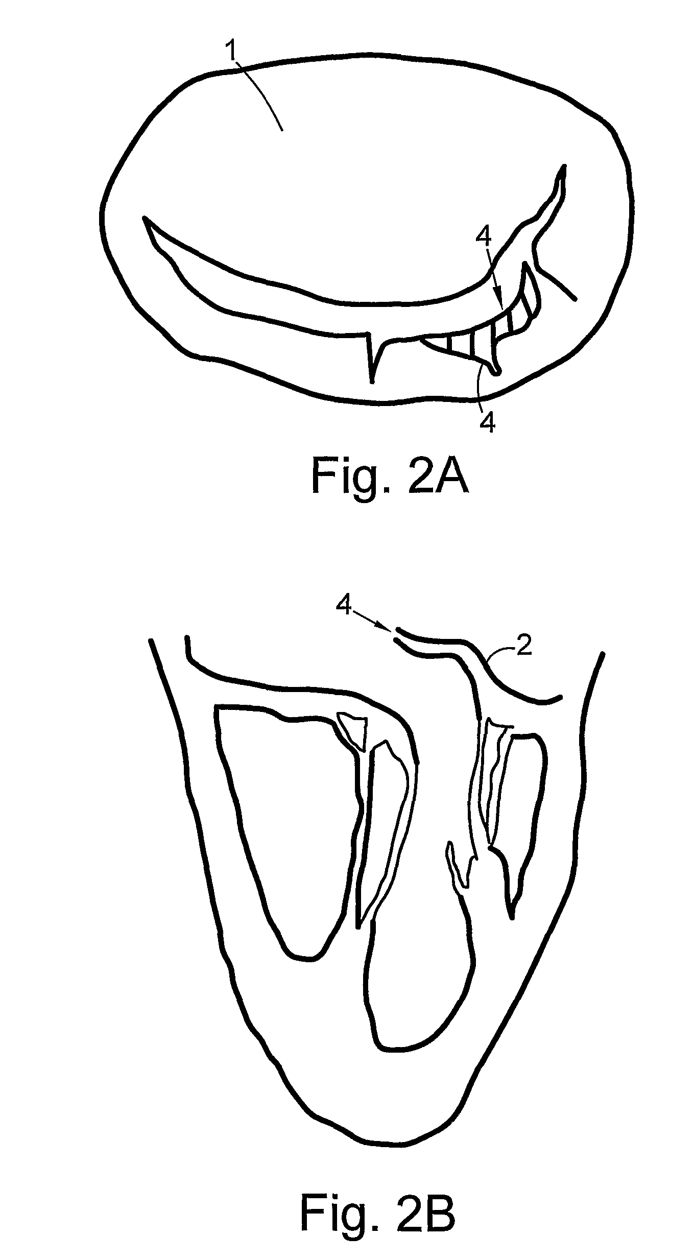 Heart valve repair