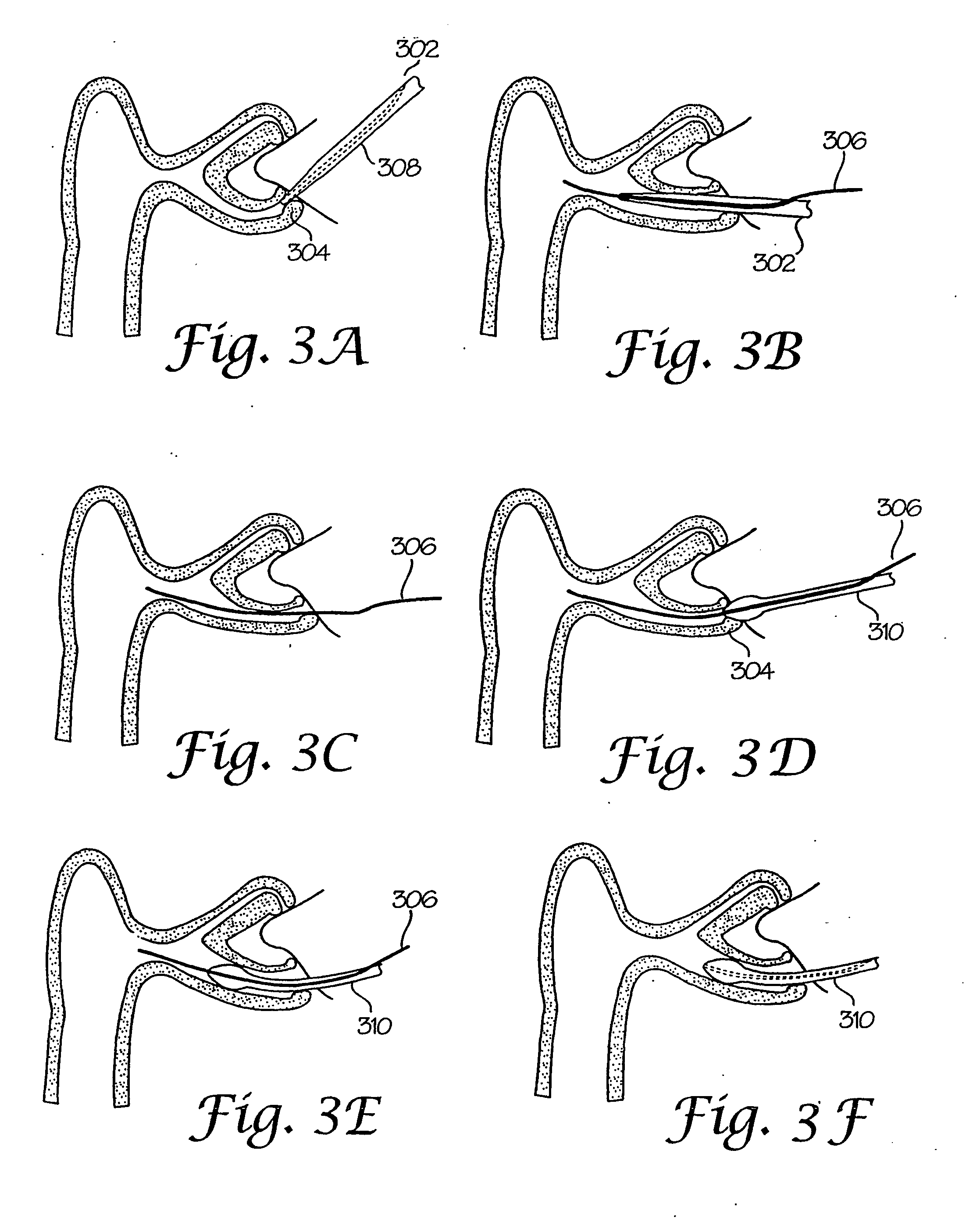 Device for insertion of lacrimal stents