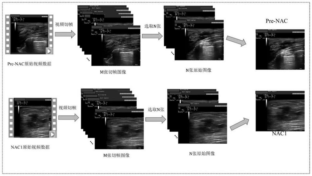 Early prediction method for curative effect of cancer chemotherapy based on two-channel convolutional neural network