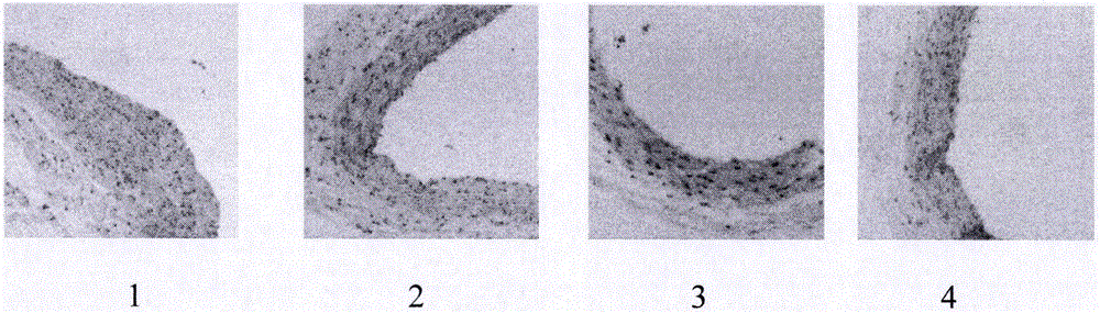 Pharmaceutical composition for treating atherosclerosis and application thereof