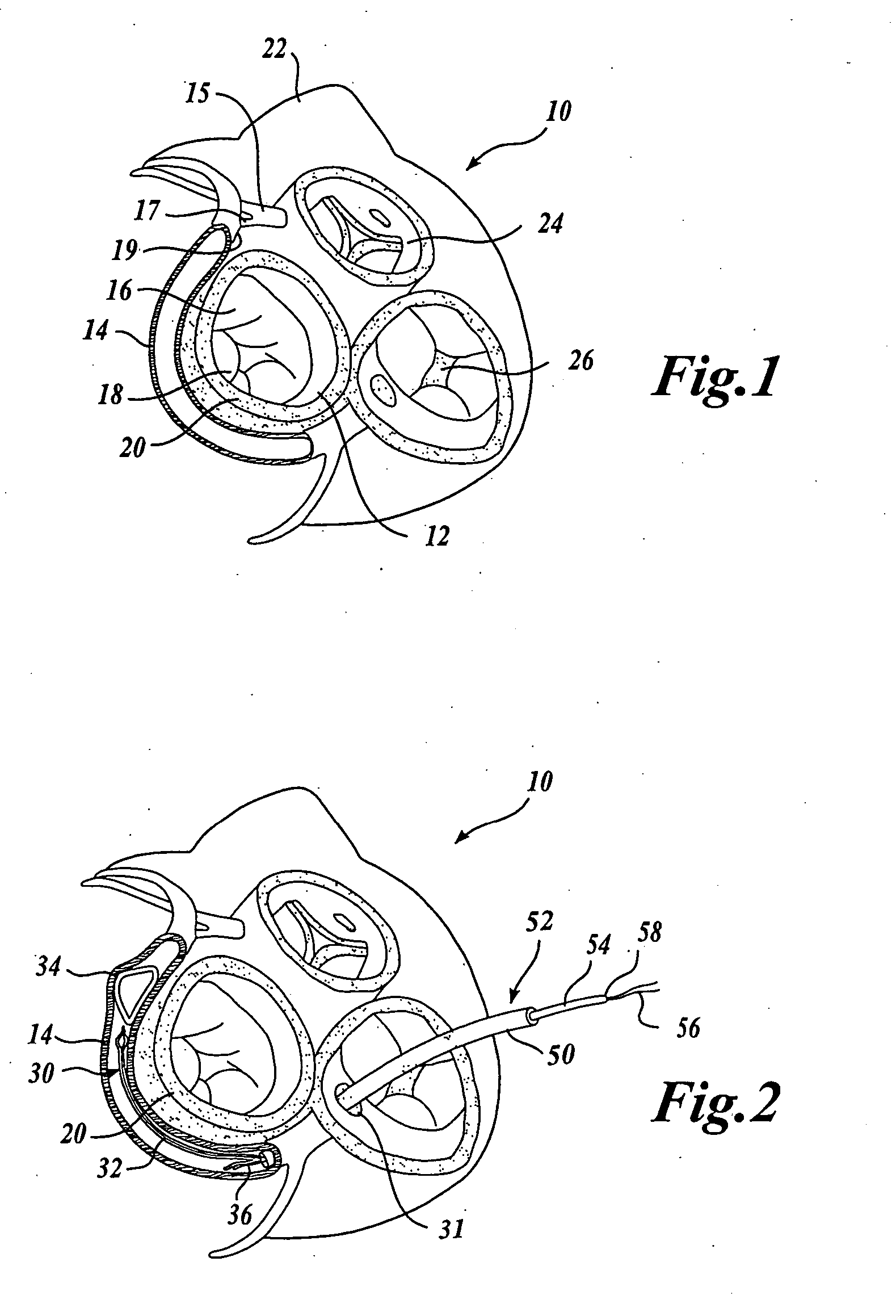 Body lumen device anchor, device and assembly